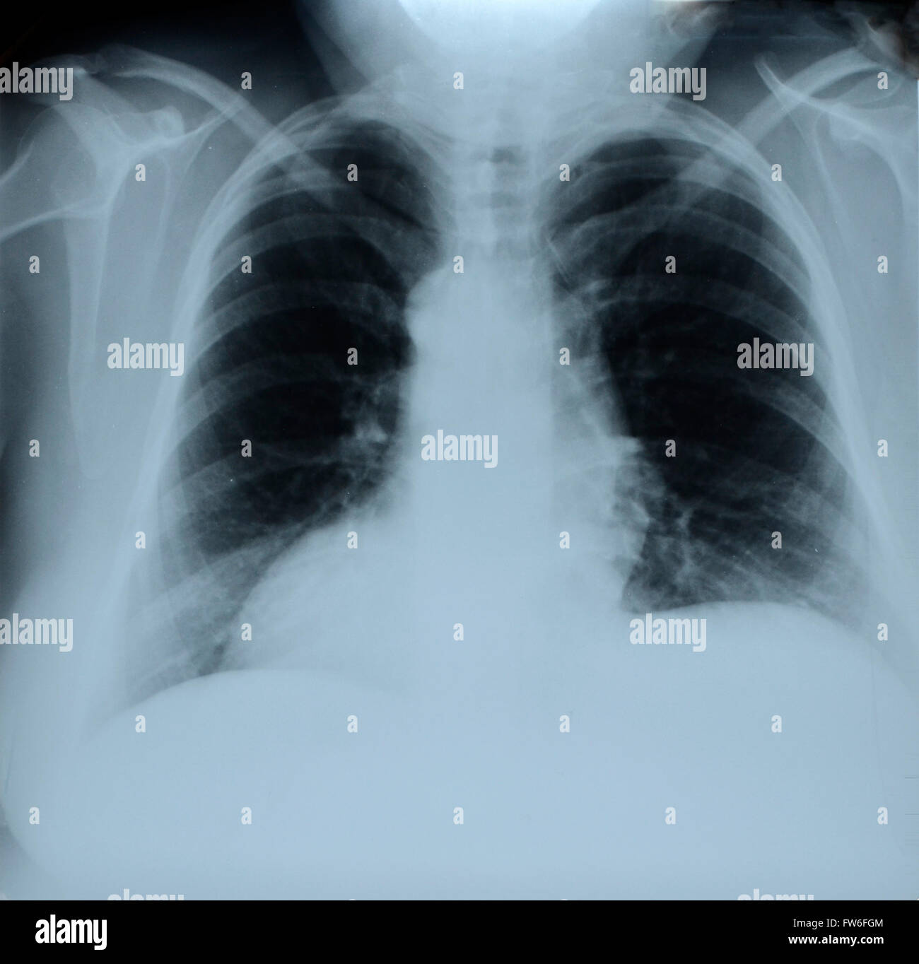 Radiographie de la poitrine humaine Banque D'Images