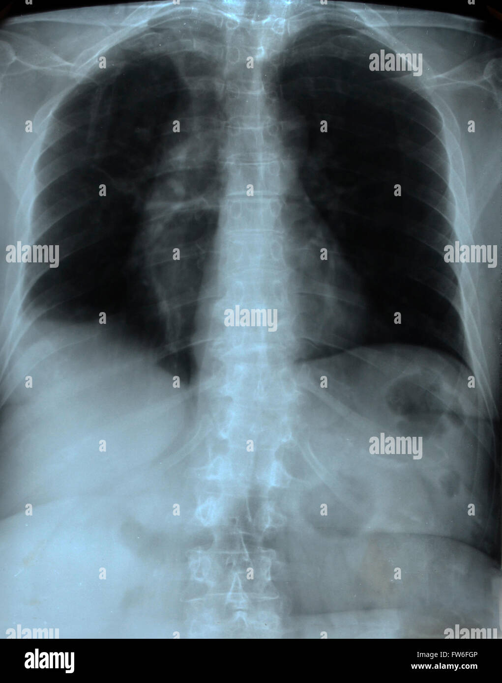 Radiographie de la poitrine humaine Banque D'Images