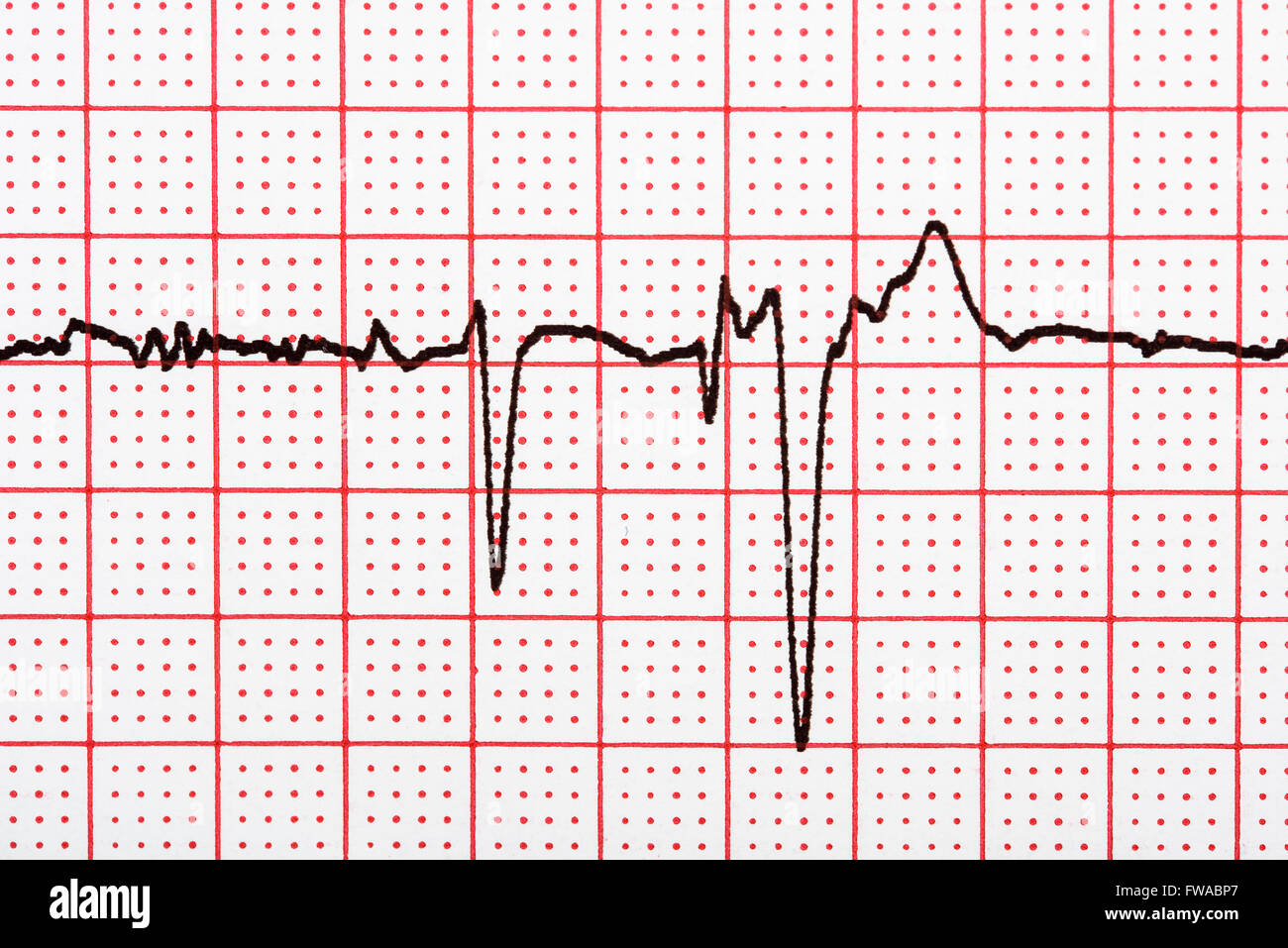 Extrasystole sur l'enregistrement de l'électrocardiogramme 12 dérivations Paper Banque D'Images