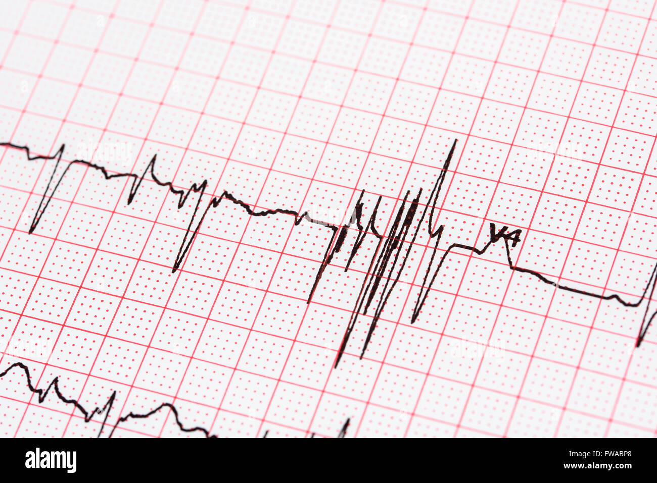 Extrasystole sur l'enregistrement de l'électrocardiogramme 12 dérivations Paper Banque D'Images