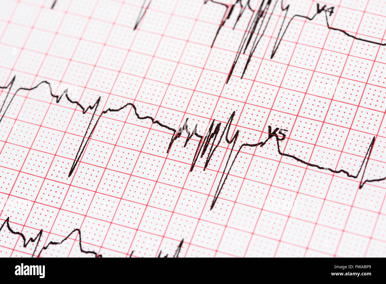 Extrasystole sur l'enregistrement de l'électrocardiogramme 12 dérivations Paper Banque D'Images