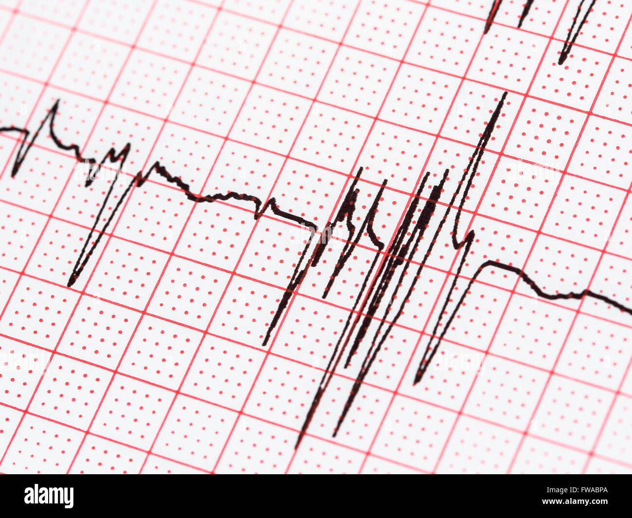 Extrasystole sur l'enregistrement de l'électrocardiogramme 12 dérivations Paper Banque D'Images