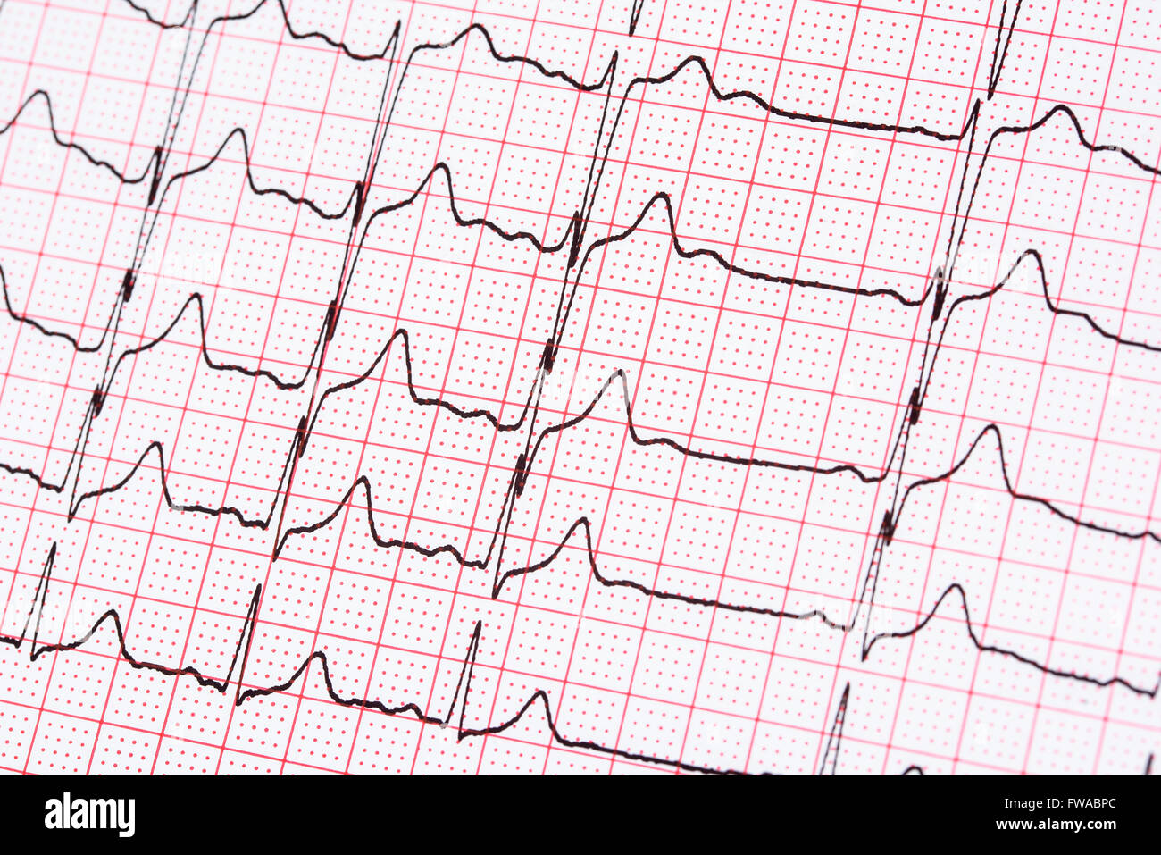Extrasystole sur l'enregistrement de l'électrocardiogramme 12 dérivations Paper Banque D'Images