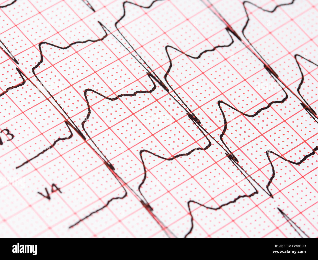 Extrasystole sur l'enregistrement de l'électrocardiogramme 12 dérivations Paper Banque D'Images