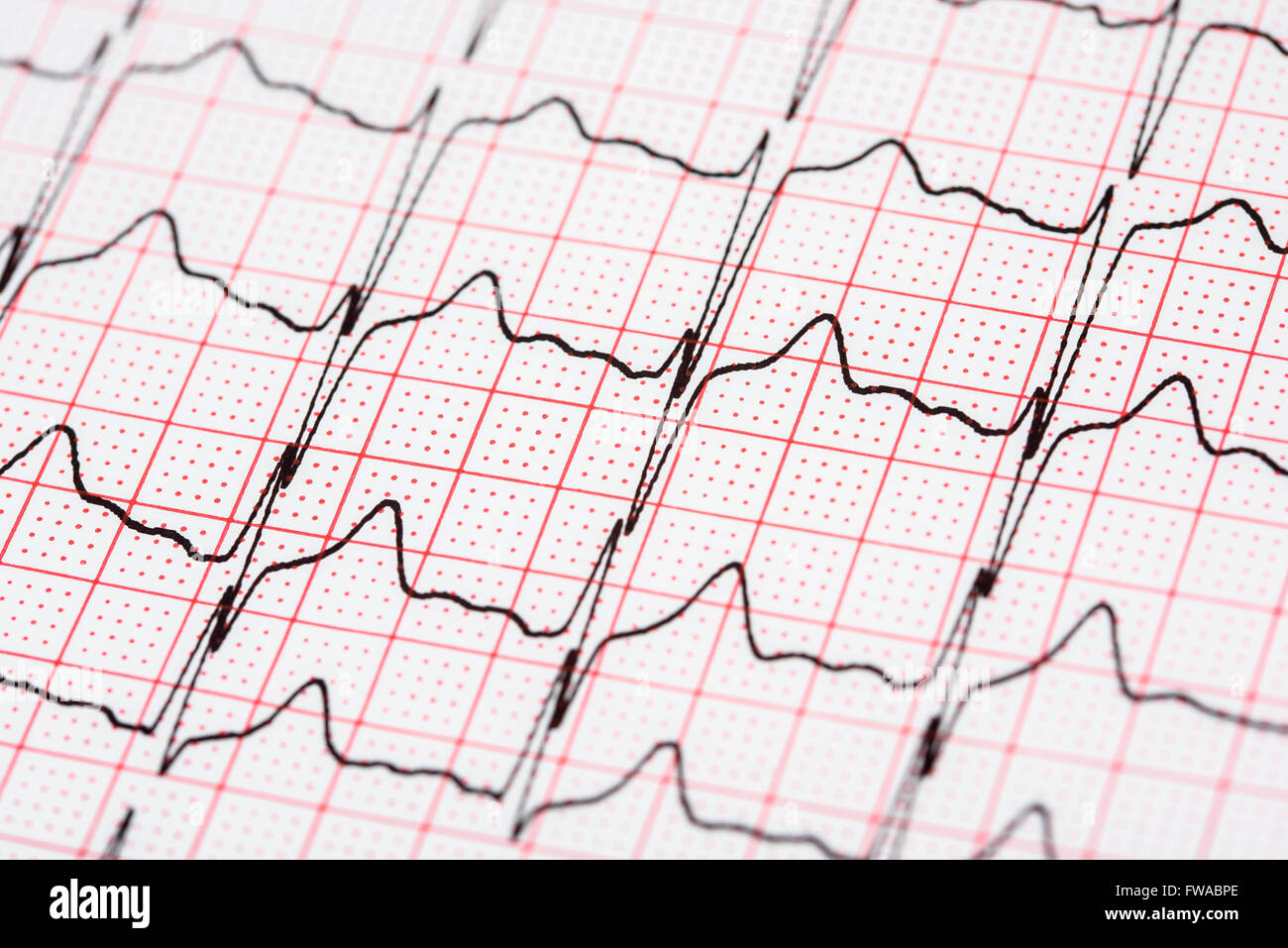 Extrasystole sur l'enregistrement de l'électrocardiogramme 12 dérivations Paper Banque D'Images
