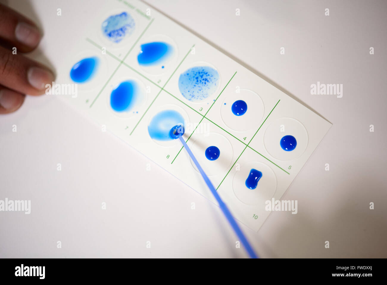 La fièvre des résultats positifs de tests bleu carte Mononucléose tests sont des tests sanguins pour rechercher des anticorps qui indiquent la mononucléose Banque D'Images