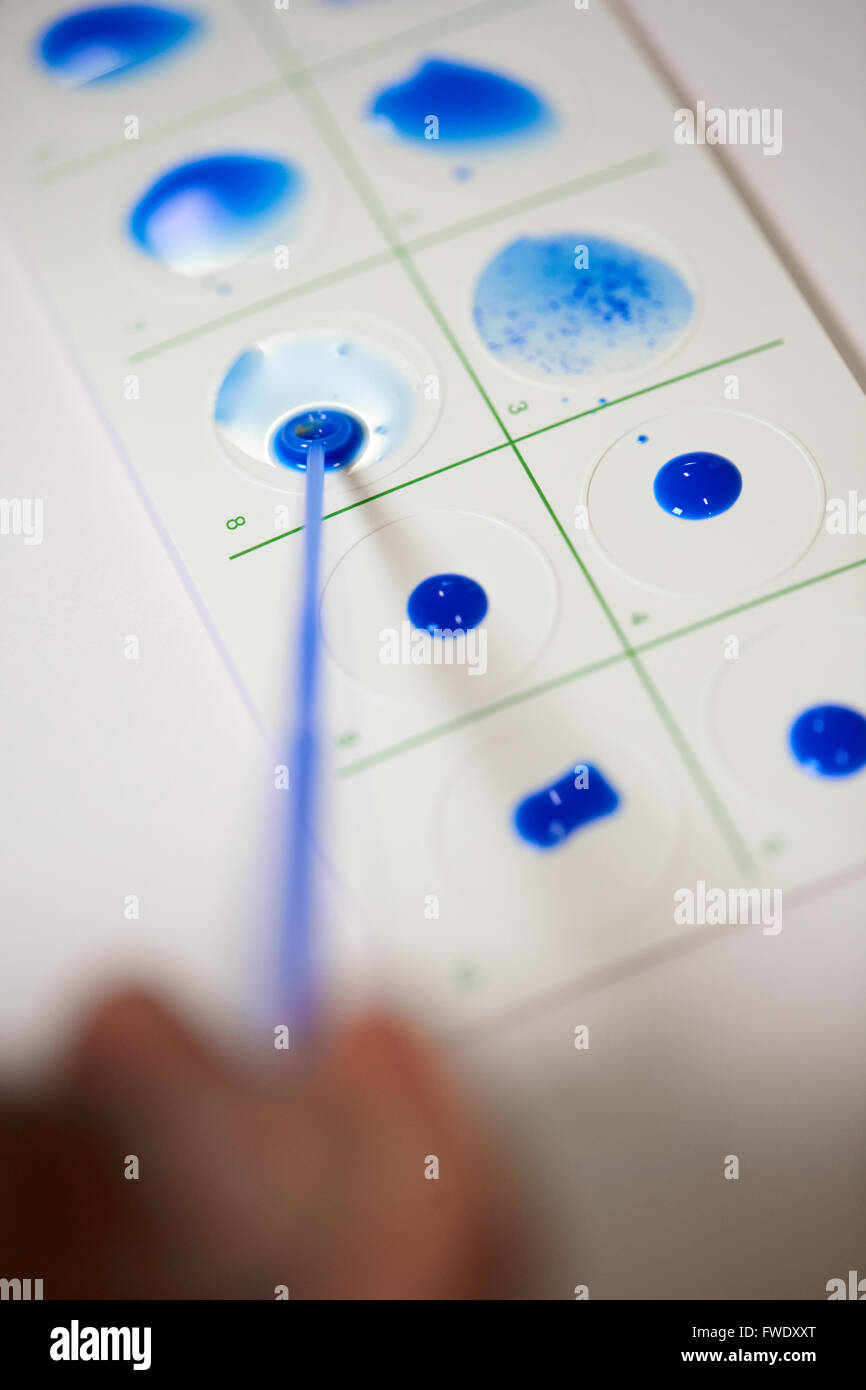 La fièvre des résultats positifs de tests bleu carte Mononucléose tests sont des tests sanguins pour rechercher des anticorps qui indiquent la mononucléose Banque D'Images