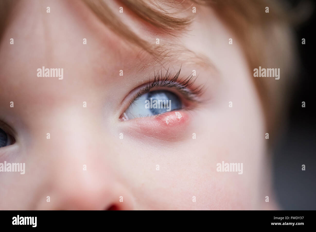 Hordeolum Banque D Image Et Photos Alamy Hordeolum Banque D Image Et Photos Alamy