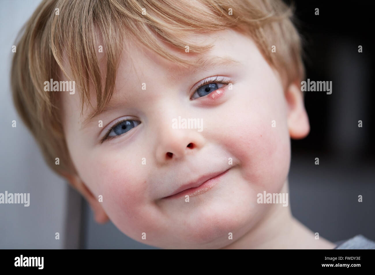 Un Orgelet Externe Ou Sty Aussi Orgelet Est Une Infection Des Glandes Sebacees De Zeis A La Base Des Cils Ou D Une Infe Photo Stock Alamy
