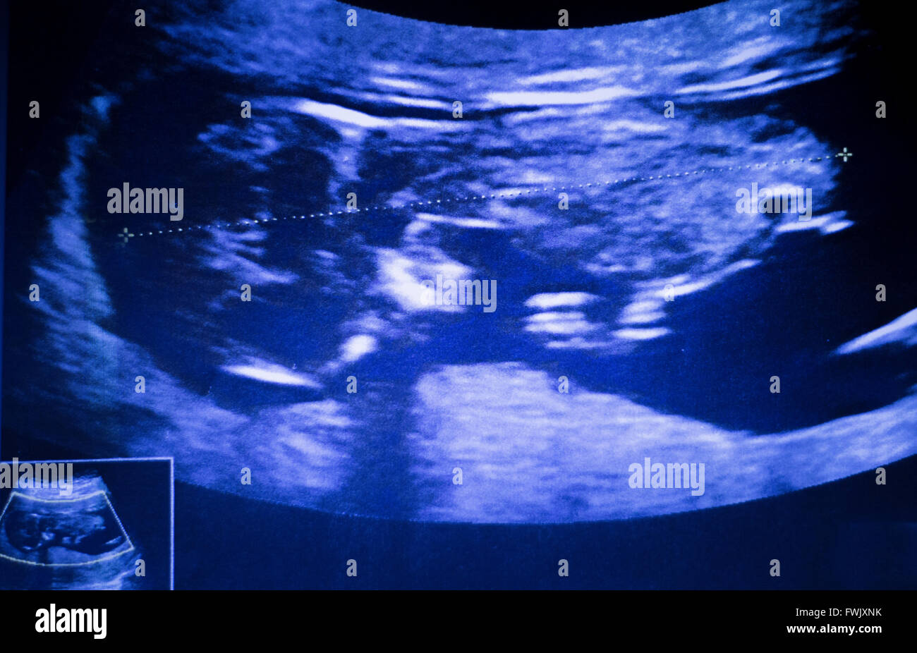 L'échographie foetus 3 mois le ventre de femme enceinte grossesse scan de bébés en santé. Banque D'Images