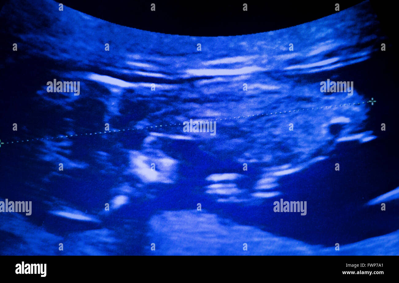 L Echographie Foetus 3 Mois Le Ventre De Femme Enceinte Grossesse Scan De Bebes En Sante Photo Stock Alamy