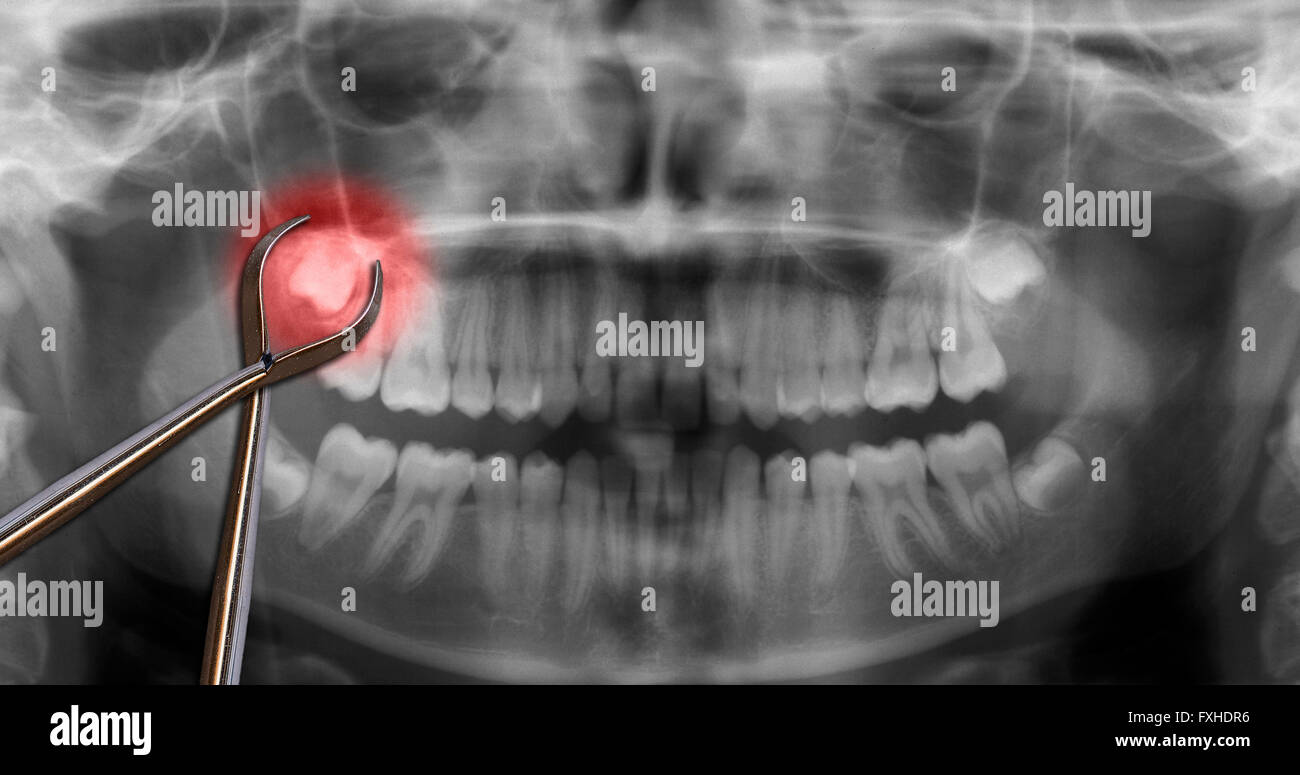 Outils d'orthodontie montrer les dents de sagesse sur scan dentaire Banque D'Images