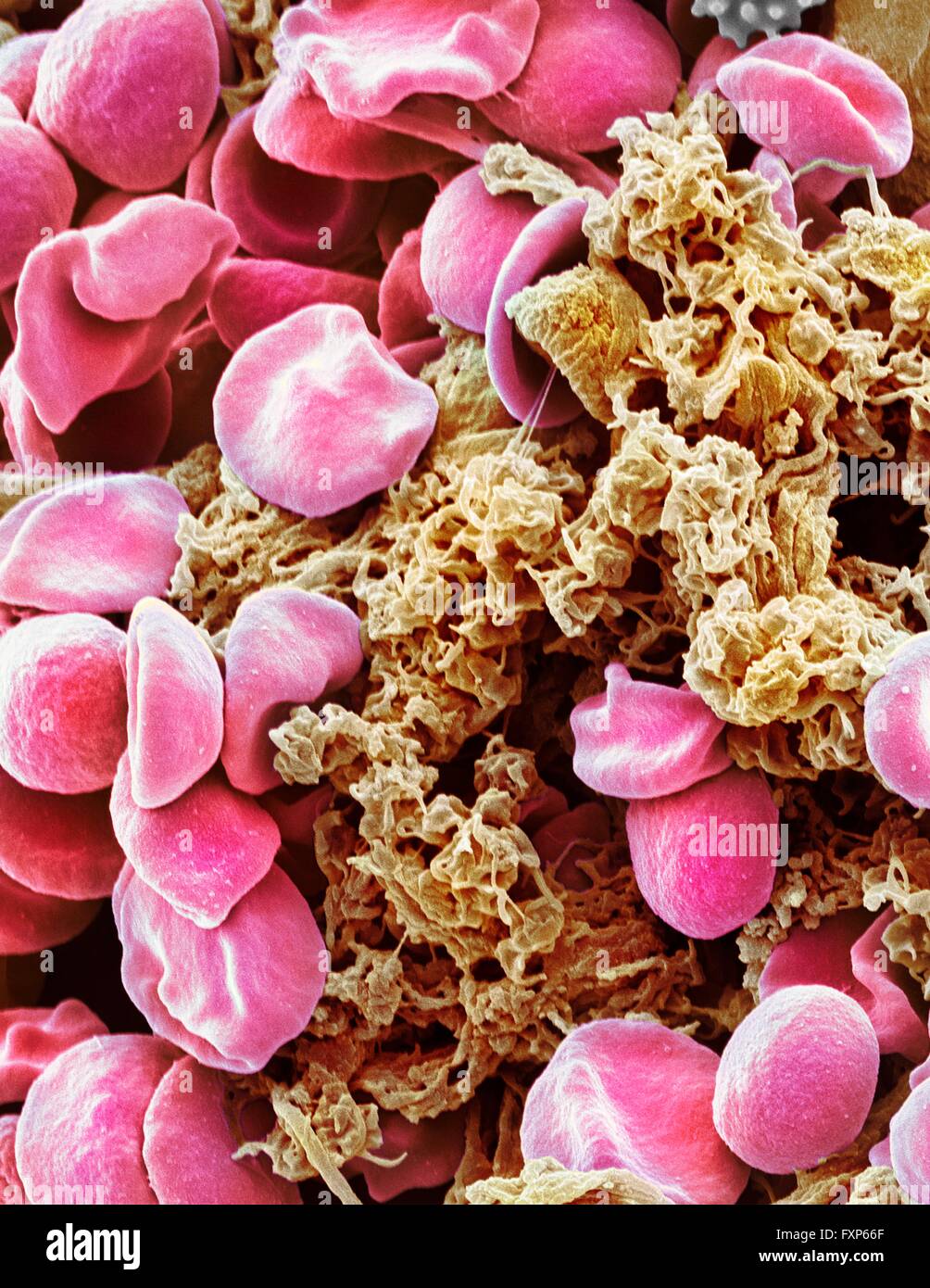 Globules rouges et les plaquettes. Couleur de l'analyse microscope Microphotographie (SEM) des érythrocytes (globules rouges) et un agrégat plaquettaire (orange). Les plaquettes sont des fragments de cellules de sang blanches qui, dans des circonstances normales, sont de petite taille et de forme biconcave. Cependant, s'il y a une rupture de la surface d'un vaisseau sanguin, les plaquettes sont en contact avec des molécules qu'elles ne sont pas utilisées pour devenir et activé. Ils deviennent informe, en forme, avec de longues projections (pseudopodes) qui leur permettent d'adhérer à d'autres cellules et l'autre, formant un caillot. Agrandissement : x3000 lors de l'impression à 10 centimètres Banque D'Images