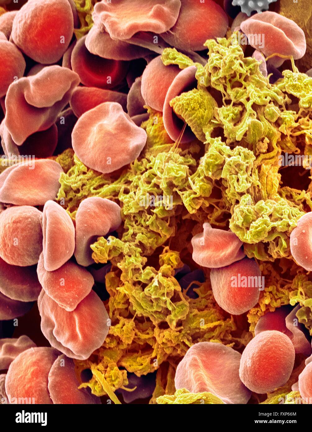 Globules rouges et les plaquettes. Couleur de l'analyse microscope Microphotographie (SEM) des érythrocytes (globules rouges) et un agrégat plaquettaire (jaune). Les plaquettes sont des fragments de cellules de sang blanches qui, dans des circonstances normales, sont de petite taille et de forme biconcave. Cependant, s'il y a une rupture de la surface d'un vaisseau sanguin, les plaquettes sont en contact avec des molécules qu'elles ne sont pas utilisées pour devenir et activé. Ils deviennent informe, en forme, avec de longues projections (pseudopodes) qui leur permettent d'adhérer à d'autres cellules et l'autre, formant un caillot. Agrandissement : x3000 lors de l'impression à 10 centimètres Banque D'Images