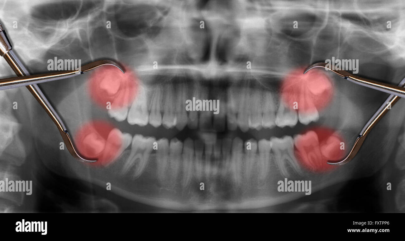 Afficher la douleur des dents de sagesse dents dentisterie Banque D'Images