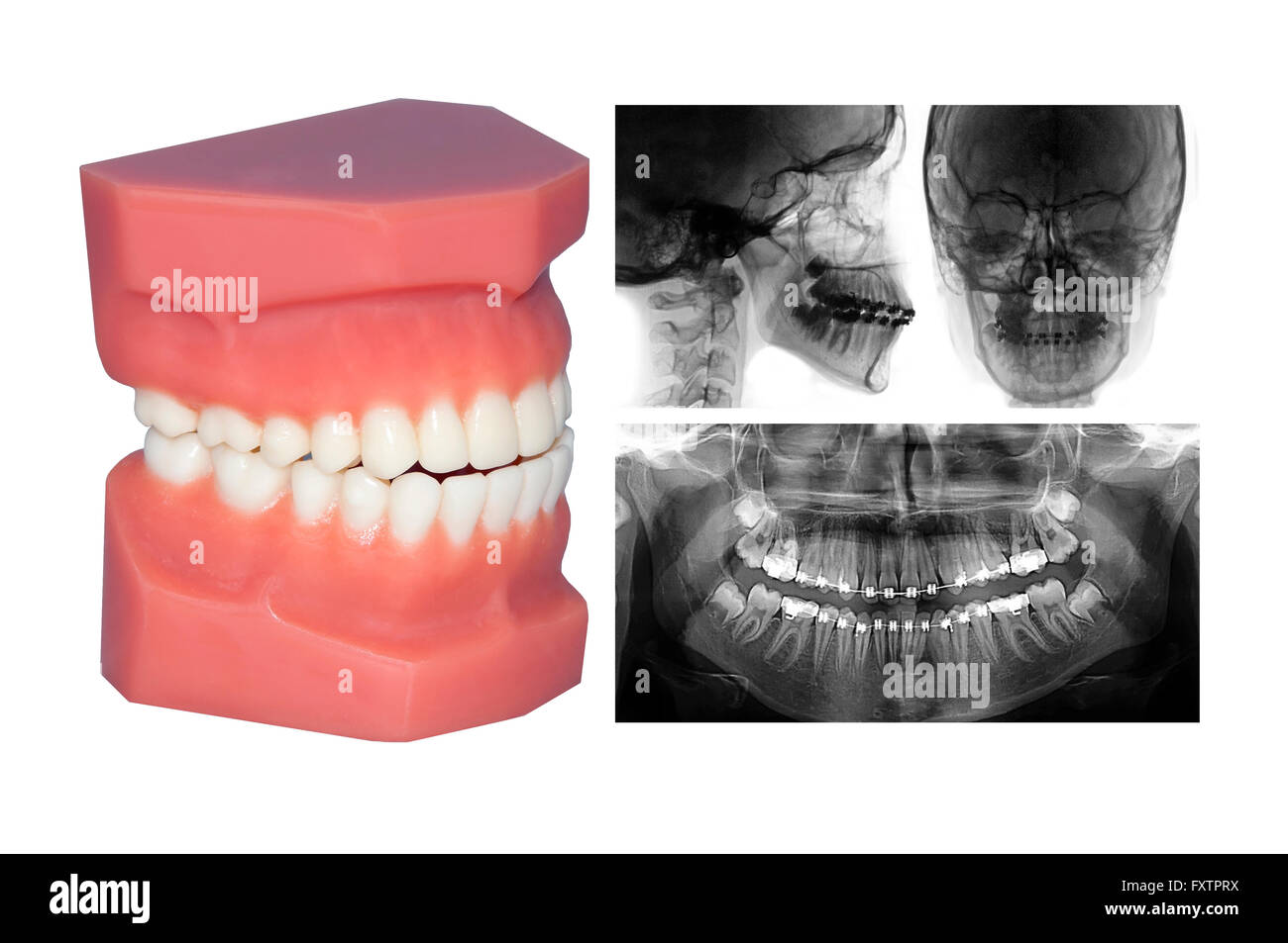 Traitement d'orthodontie réussi avec dents appareil accolades Banque D'Images