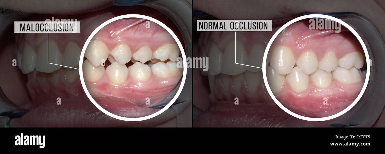 Traitement dentaire malocclusion : avant et après Banque D'Images