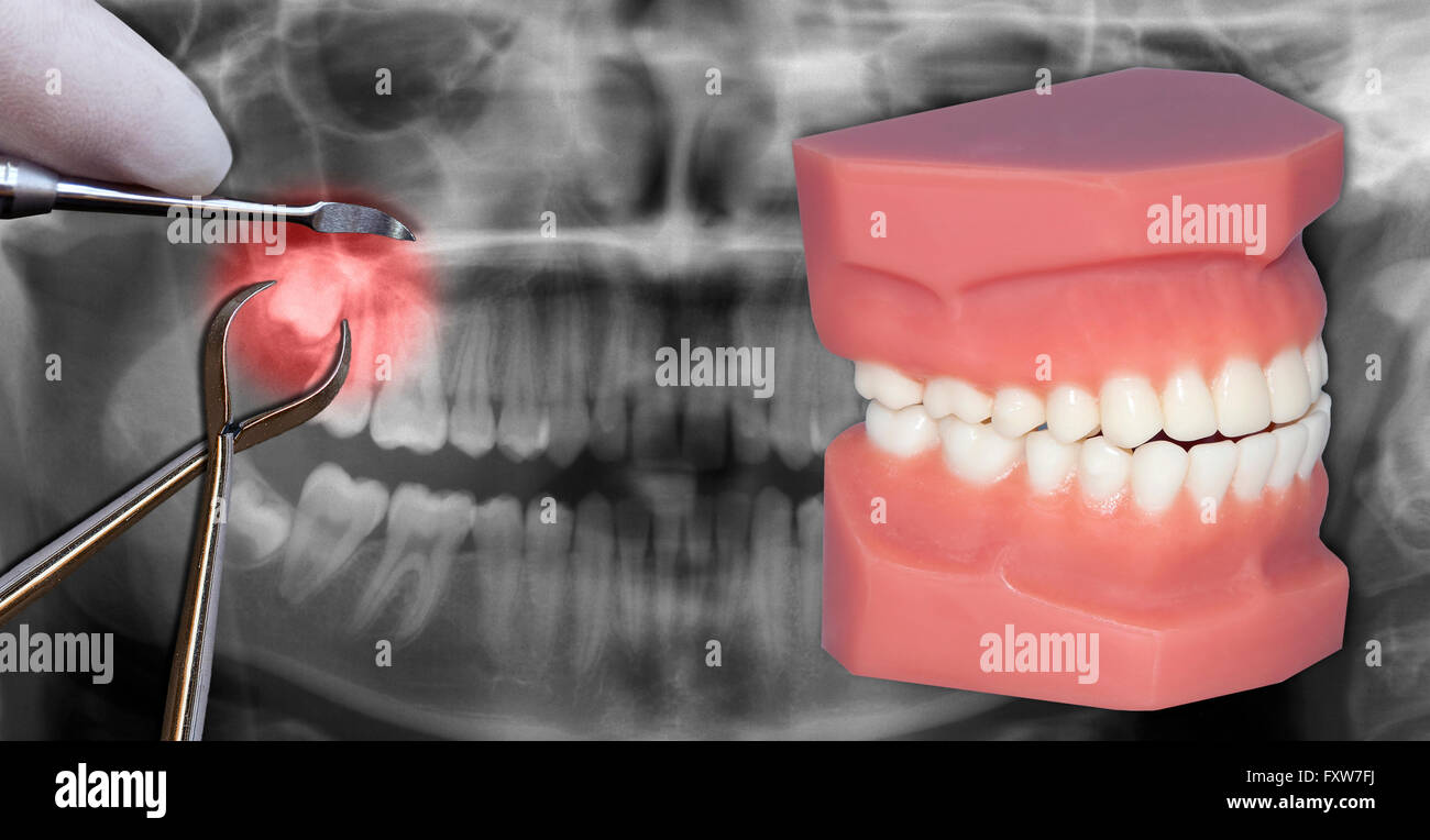 Simule l'extraction des dents de sagesse d'odontologie chirurgie dentaire Banque D'Images