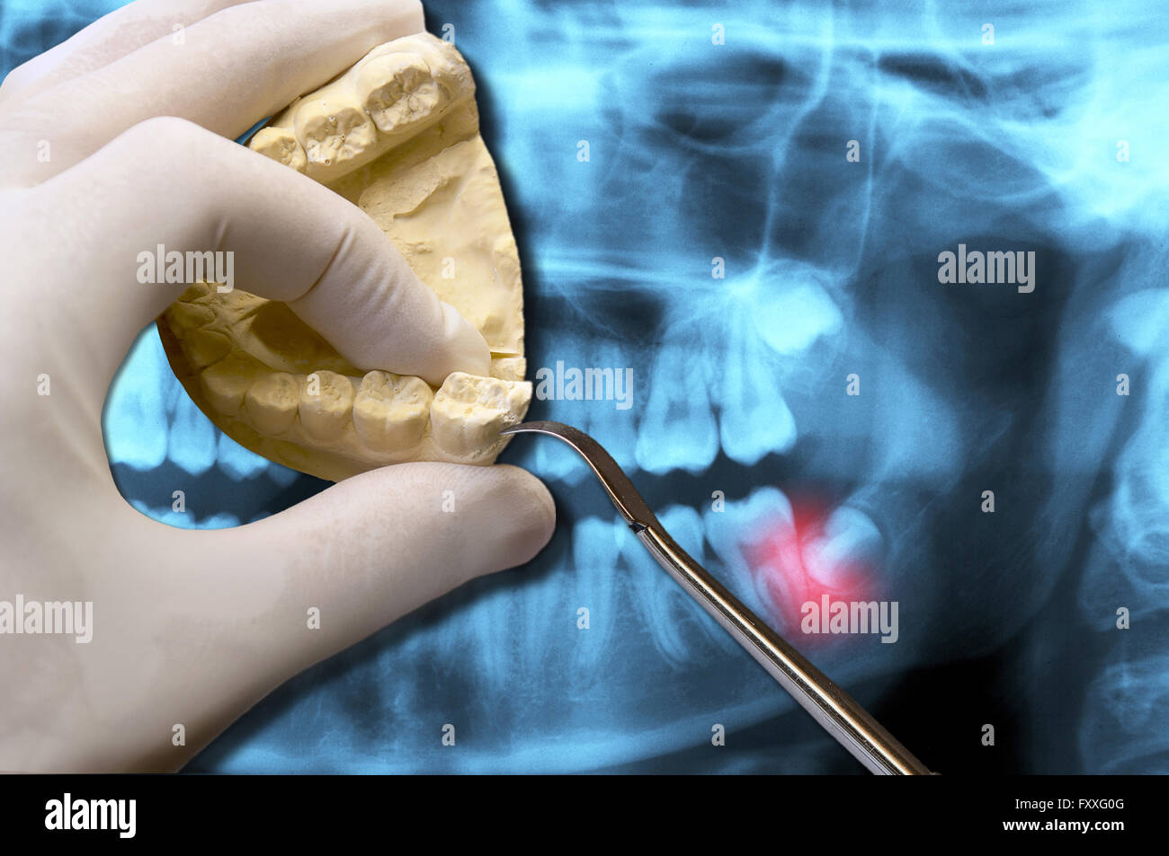 Dentiste de dents de sagesse et de montrer les dents molaires sur x-ray Banque D'Images