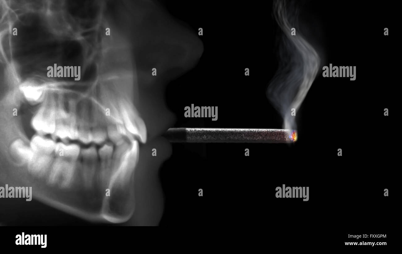 La radiographie à rayons x fumer cigarette allumée Banque D'Images