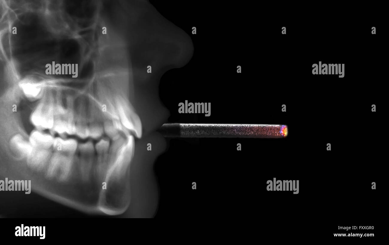 Les droits de l'x-ray cigarette Banque D'Images