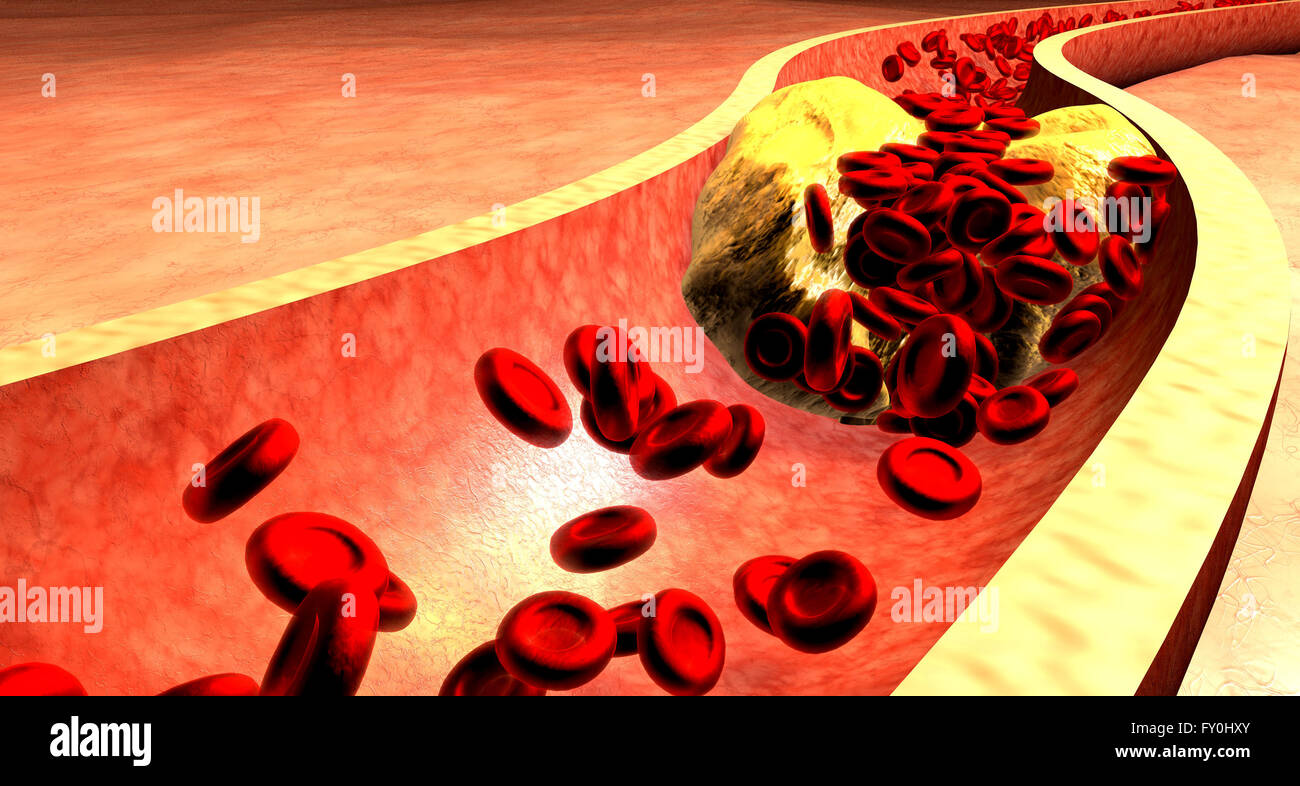 L'artère bouchée avec les plaquettes et la plaque de cholestérol. L'athérosclérose. Formation de plaques fibreuses. Banque D'Images