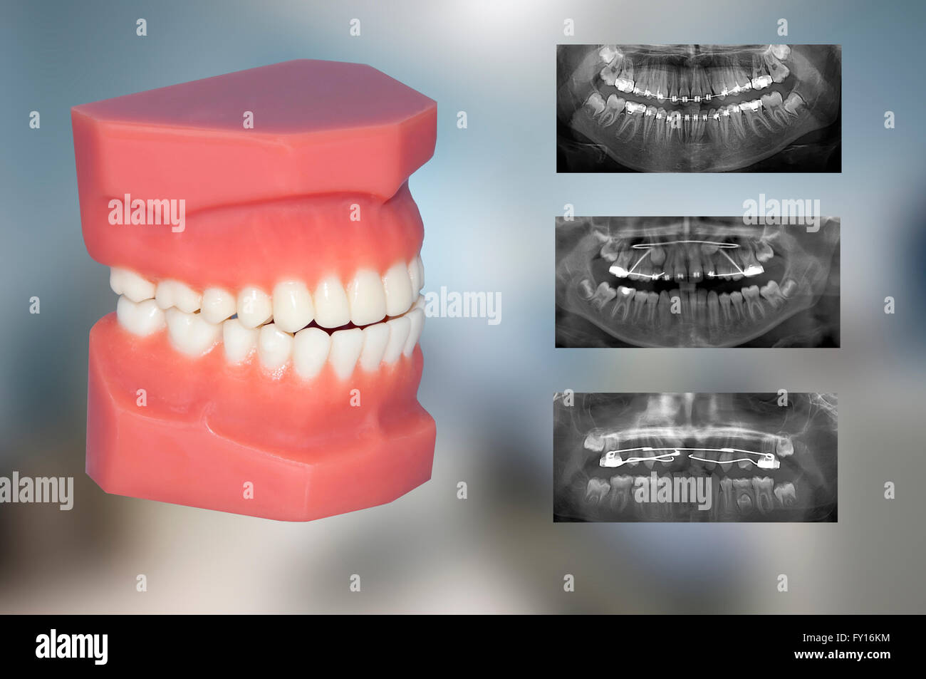 Modèle de dents et différents types d'appareils Banque D'Images