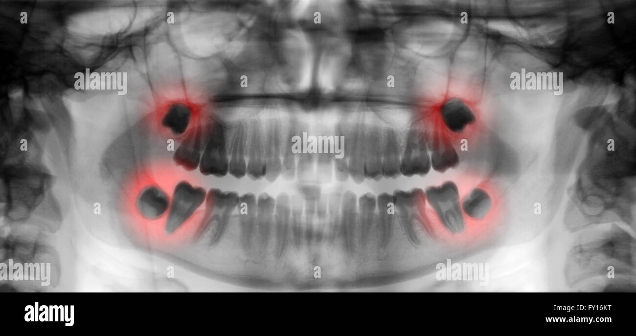 Numérisation dentaire xray afficher la sagesse et la douleur de molaires Banque D'Images