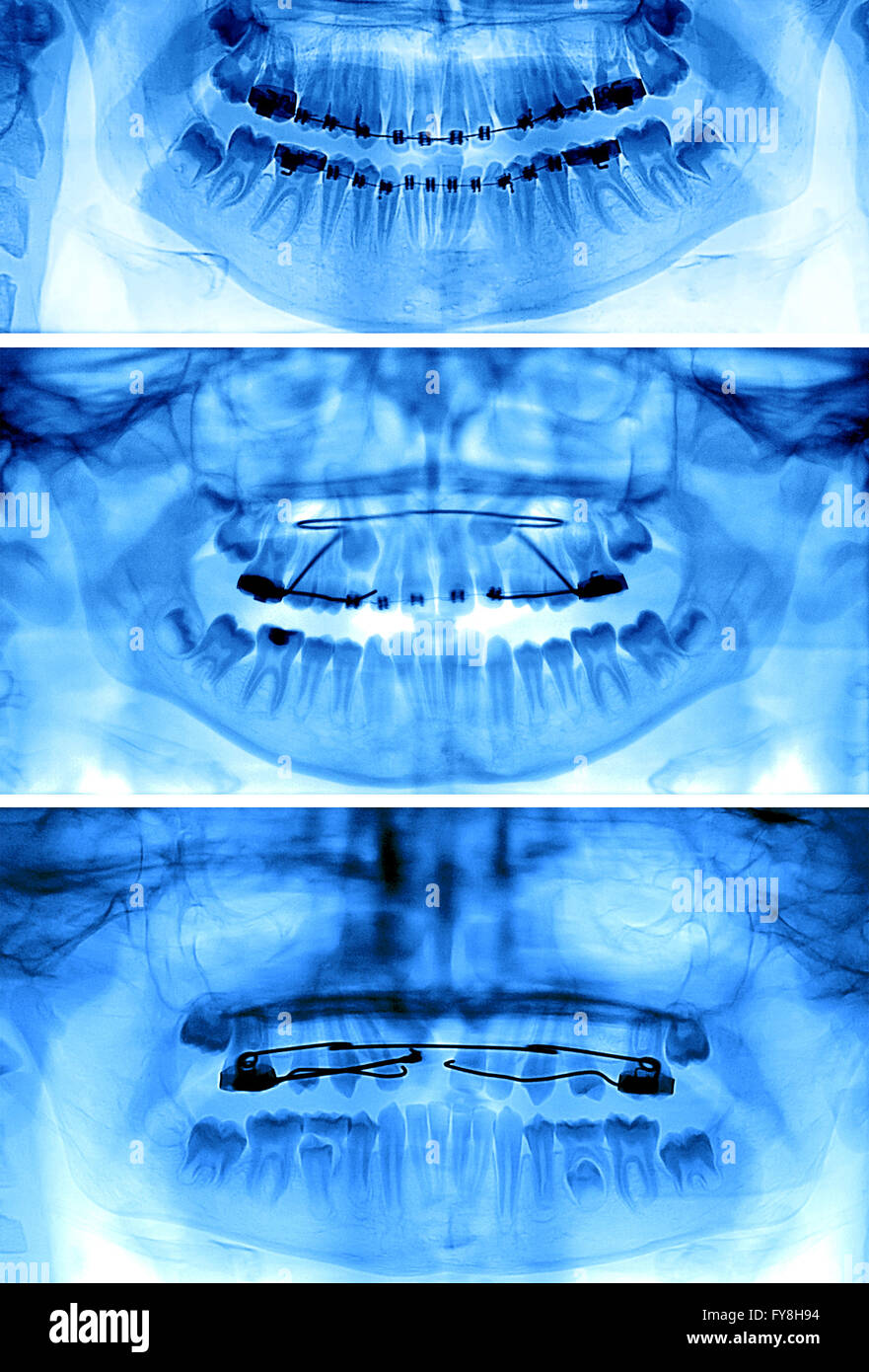 Différents appareils orthodontiques fixes et amovibles : Banque D'Images