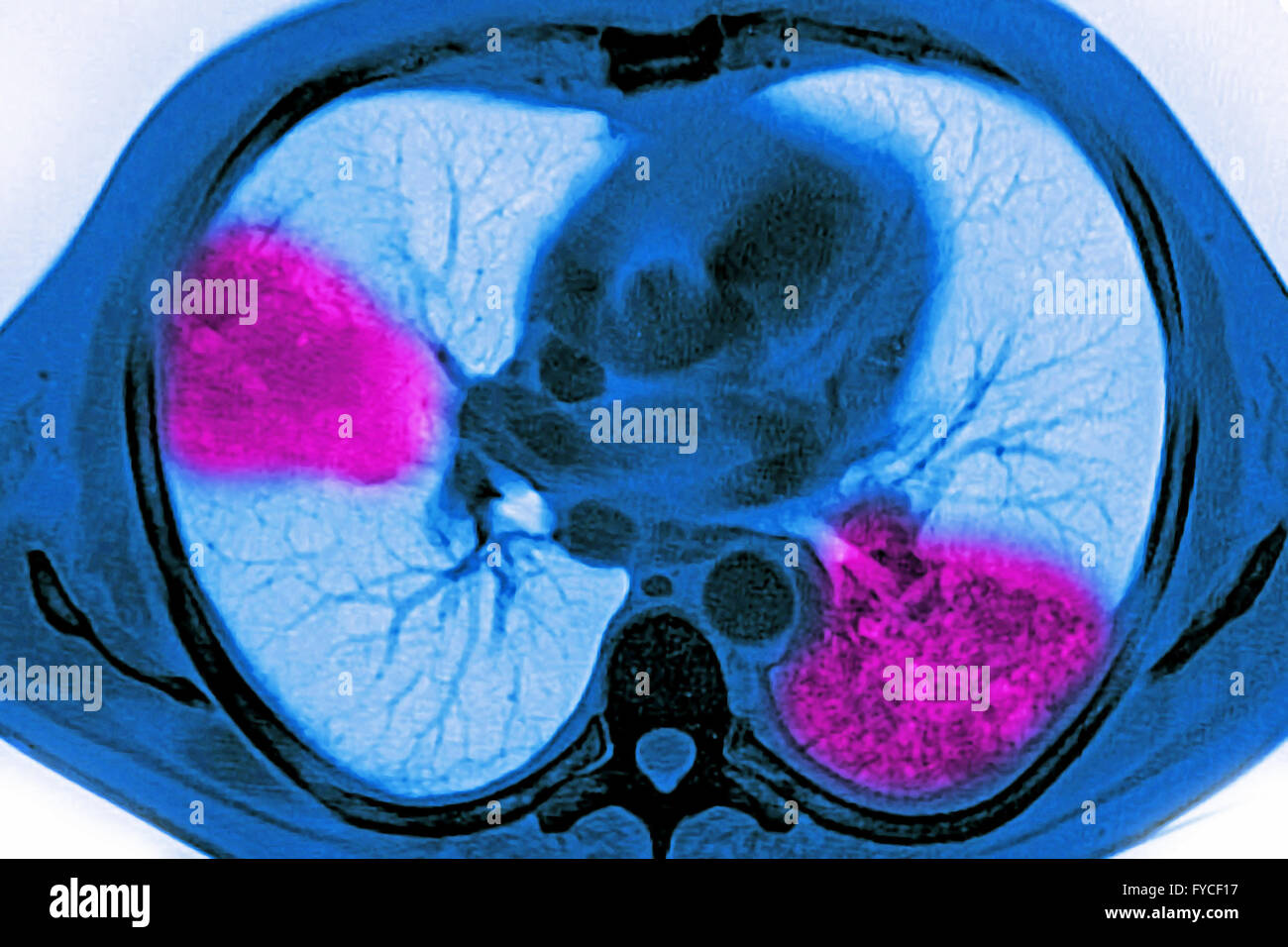 PNEUMONIE, SCAN Banque D'Images