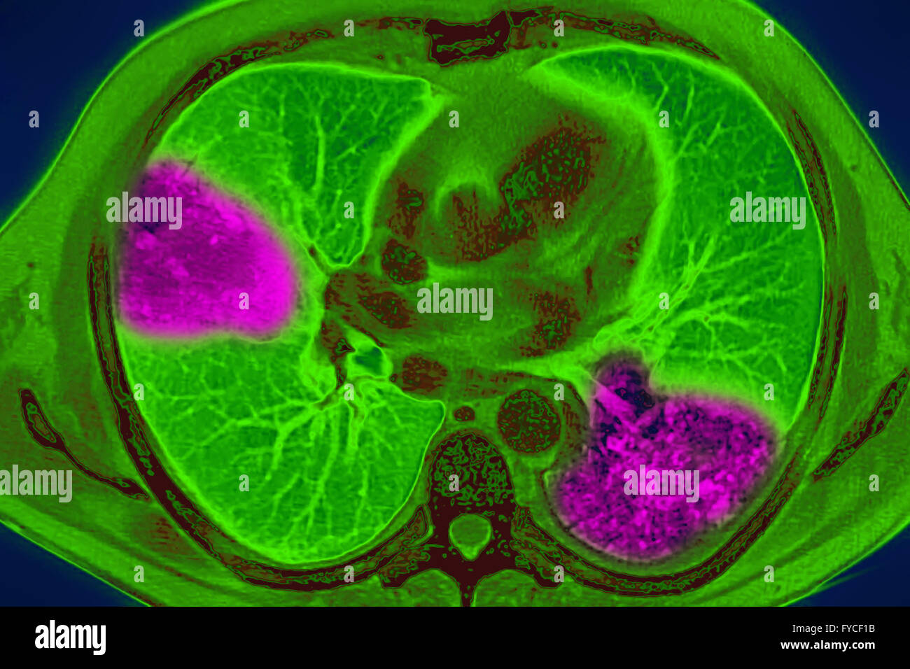 PNEUMONIE, SCAN Banque D'Images