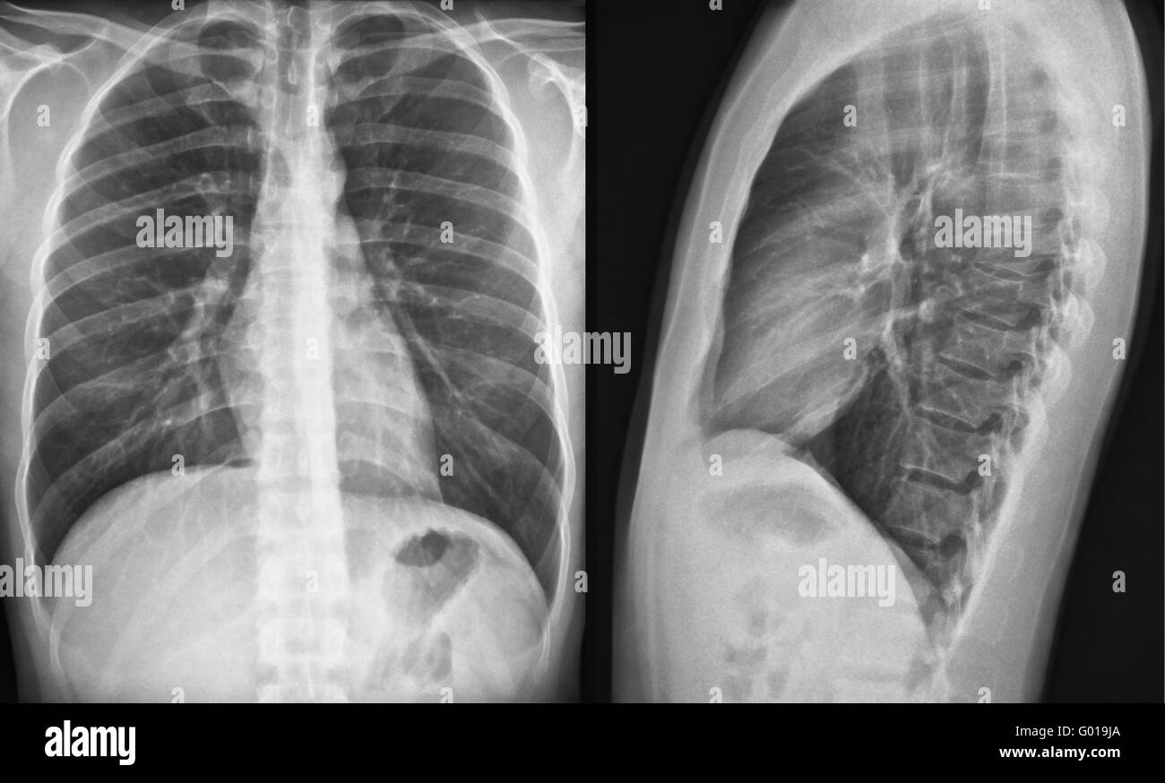Radiographie du thorax Banque D'Images