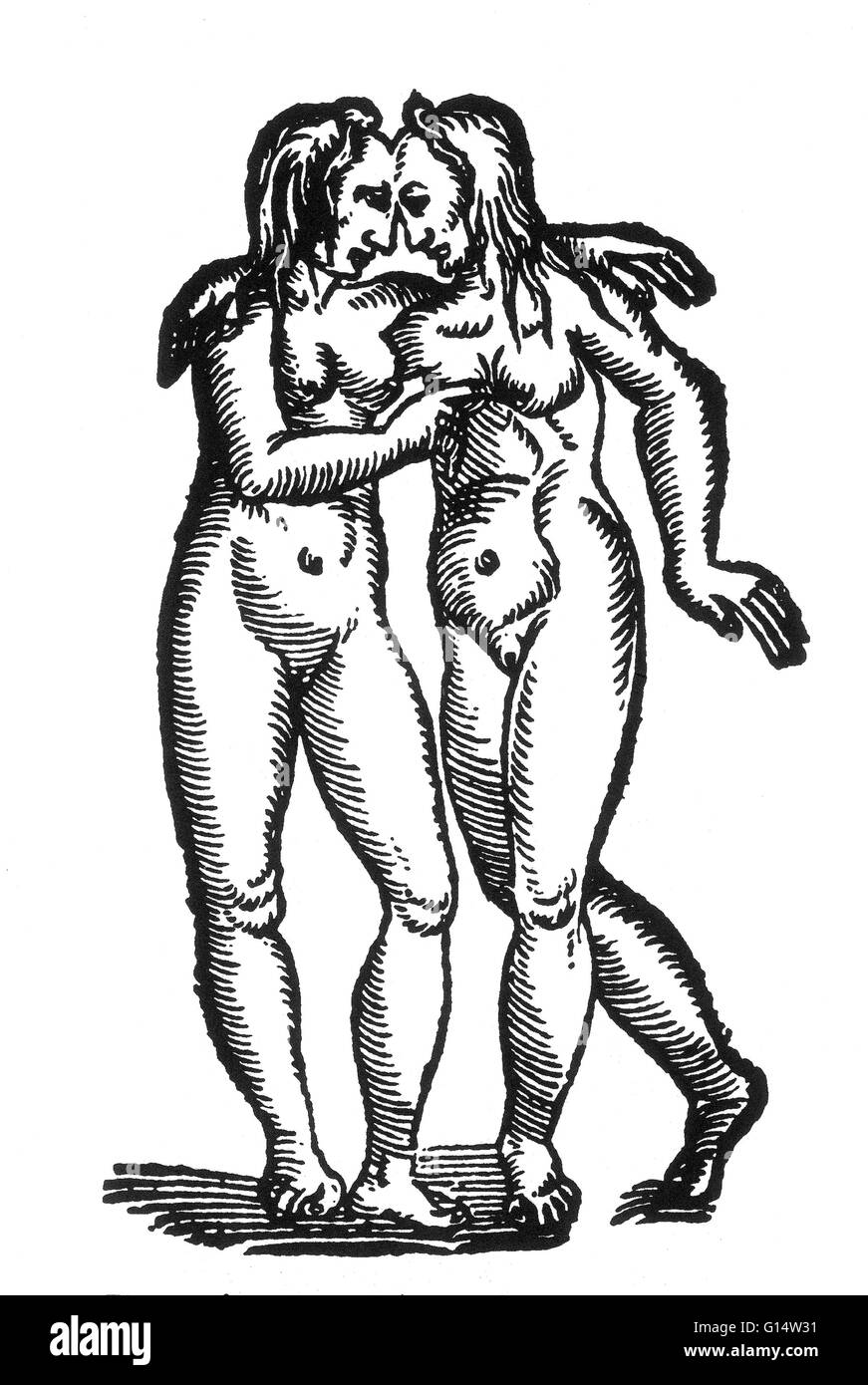 Gravure sur bois de "twin filles réunies par leur front' à partir des monstres et prodiges d'Ambroise Paré, 1573. Jumeaux siamois sont de vrais jumeaux nés avec leur corps s'est joint à un moment et d'avoir plus ou moins de résidus de duplication, la suite o Banque D'Images