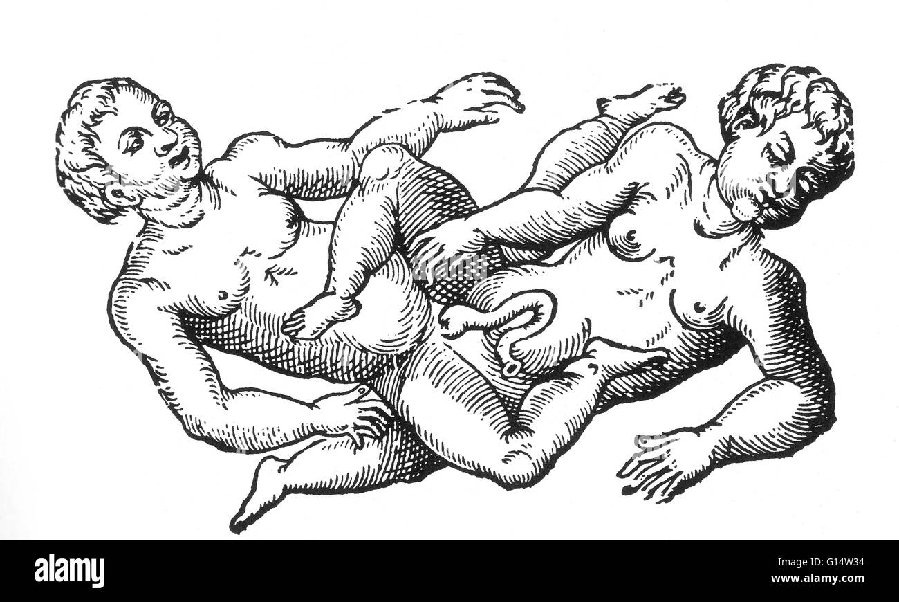 Gravure sur bois de "deux enfants nés monstrueux il n'y a pas longtemps à Paris' de des monstres et prodiges d'Ambroise Paré, 1573. Jumeaux siamois sont de vrais jumeaux nés avec leur corps s'est joint à un moment et d'avoir plus ou moins de résidus de duplication, un resu Banque D'Images