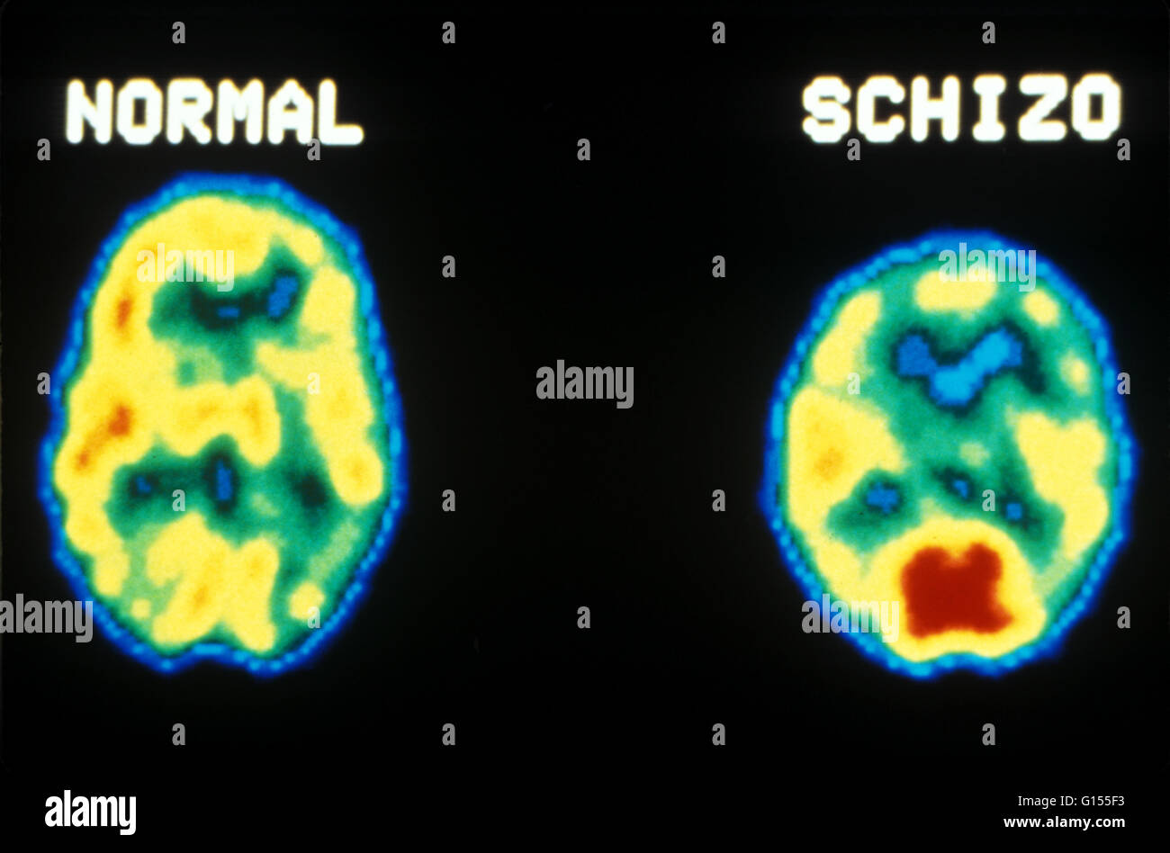 Mesure d'émission de positons (TEP) analyse : désoxyglucose étude comparant le fonctionnement normal du cerveau (à gauche) avec cerveau schizophrène (à droite). La schizophrénie se caractérise par des pensées d'illusions, hallucinations et la dépression. Banque D'Images