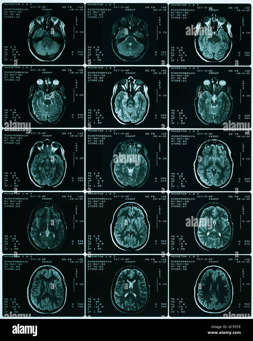 Une feuille des IRM à travers le cerveau d'une femme de 31 ans. L'IRM est normale. Banque D'Images