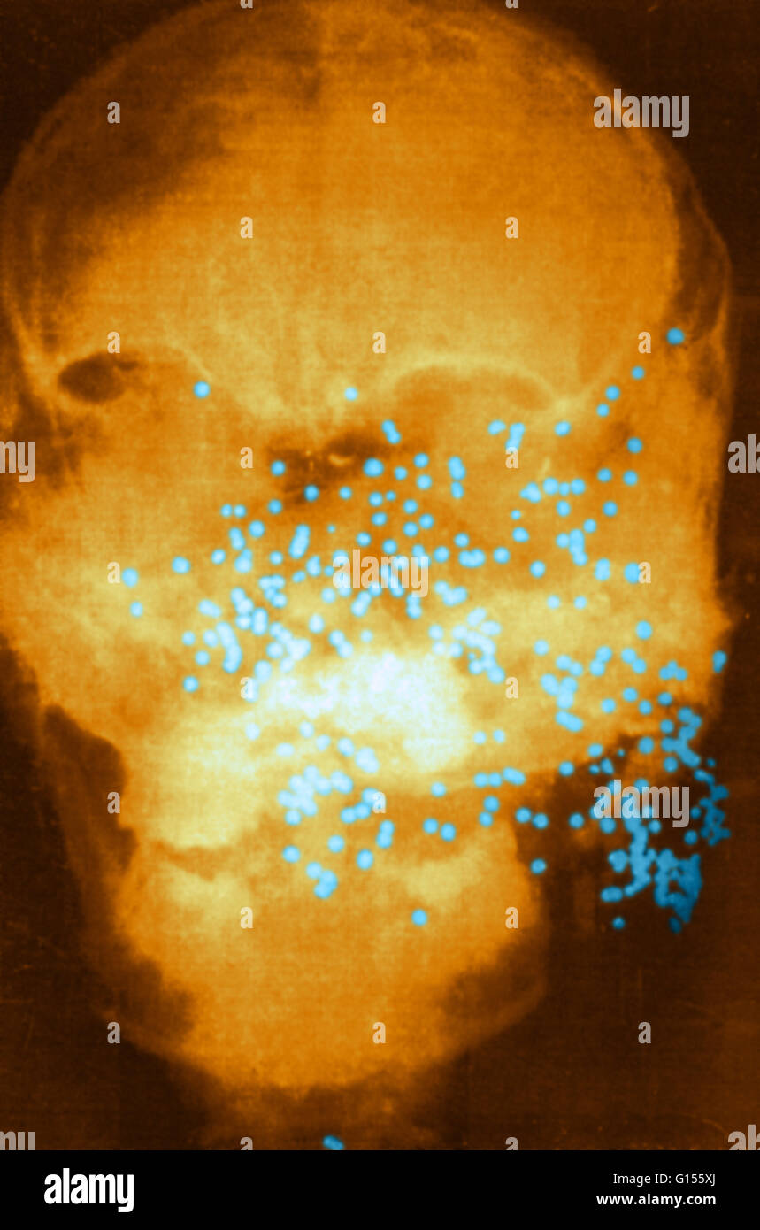 Tête renforcée couleur x-ray d'une victime de meurtre montrant des groupes de fusil de bois à travers le visage et la mâchoire. Pathologie médico-légale est une branche de la médecine utilisée à des fins juridiques et pour but de déterminer les causes de décès, l'examen des blessures dues à la criminalité Banque D'Images