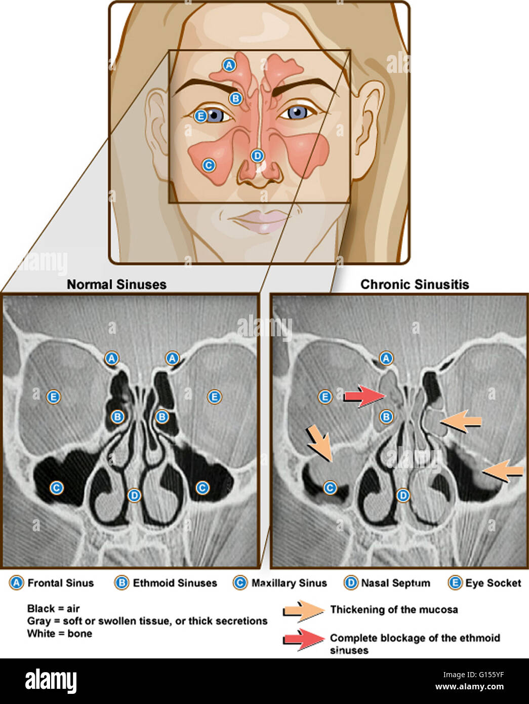 Vue avant l'illustration et side-by-side CT scan de la normale et chronique sinusistis. Étiquette : sinus frontal, sinus ethmoïde, sinus maxillaire, septum nasal, globe oculaire. La sinusite est une inflammation des sinus paranasaux, qui peut être due à l'infection, alle Banque D'Images