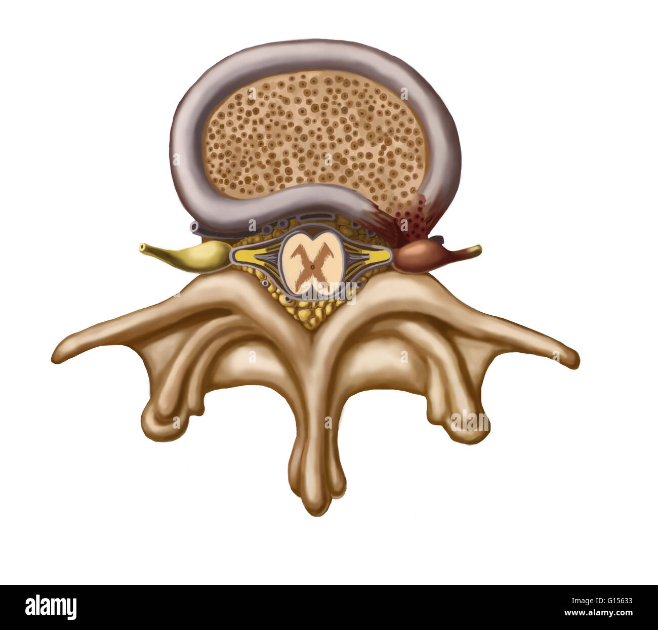 Illustration d'une vertèbre lombaire et la hernie discale (à droite). La zone brune dans l'ovale représente le disque qui, au coin inférieur droit est d'une pression sur le nerf rachidien. Au centre, le X représente la moelle épinière et au bas est t Banque D'Images