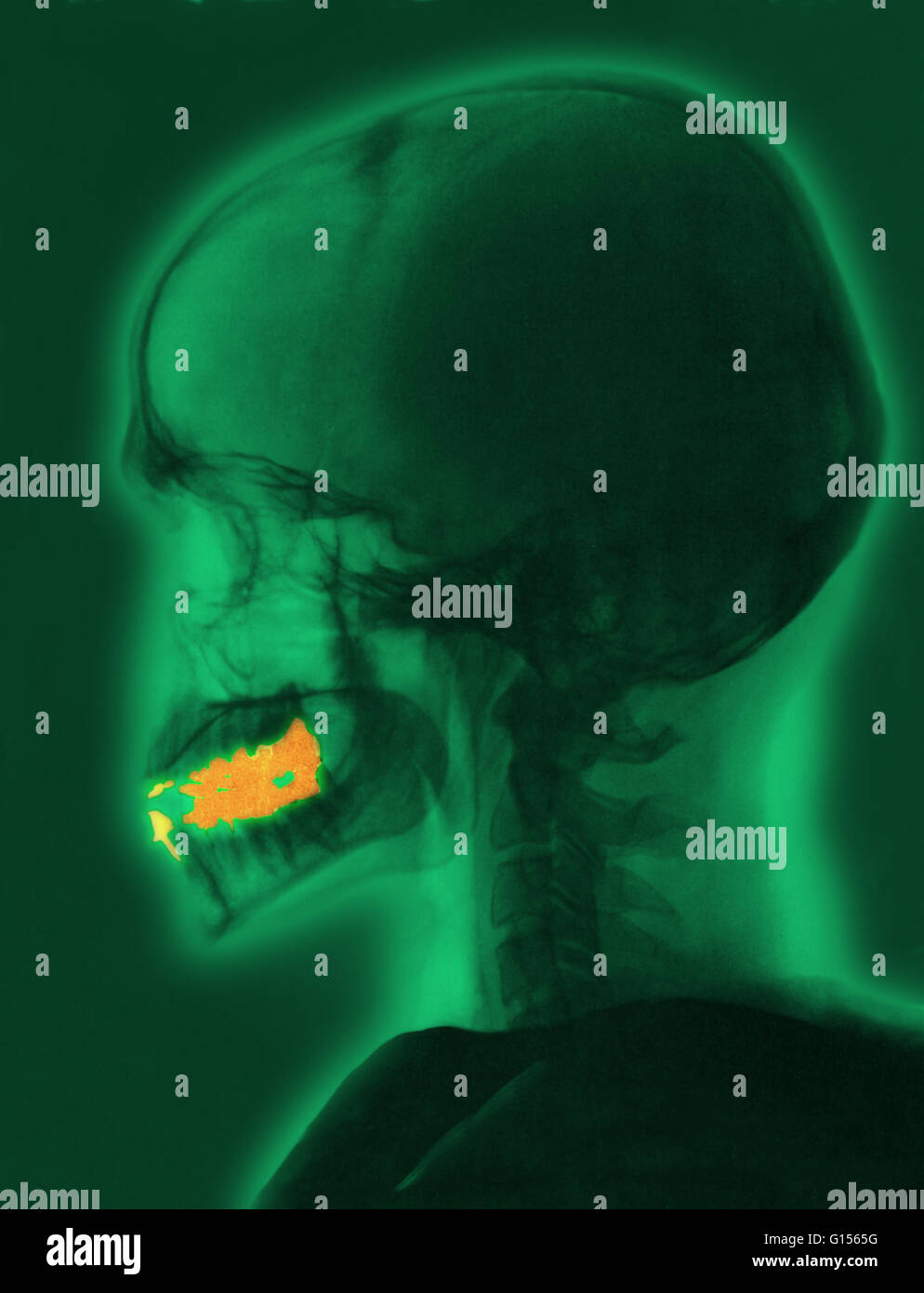 Radiographie d'un crâne d'adulte. Les zones de la bouche d'or indiquent les obturations dentaires. Banque D'Images