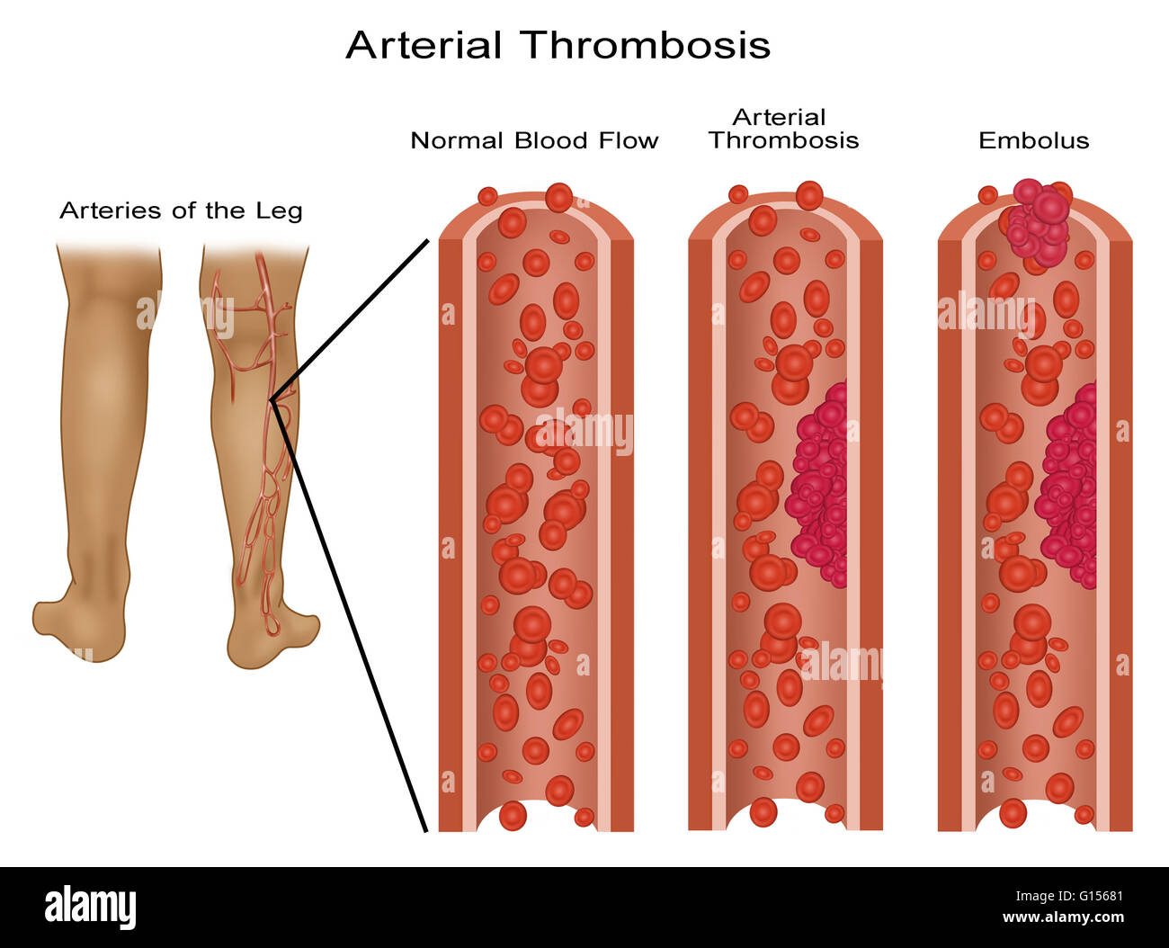 Caillots de sang dans les jambes Banque d'images détourées Alamy