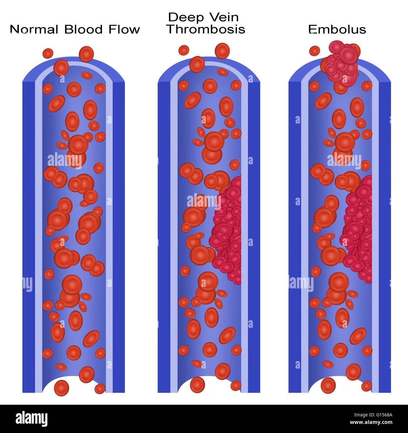 Infographie De Thrombose Veineuse Profonde Banque De Photographies Et D Infographie De Thrombose Veineuse Profonde Banque De Photographies Et D