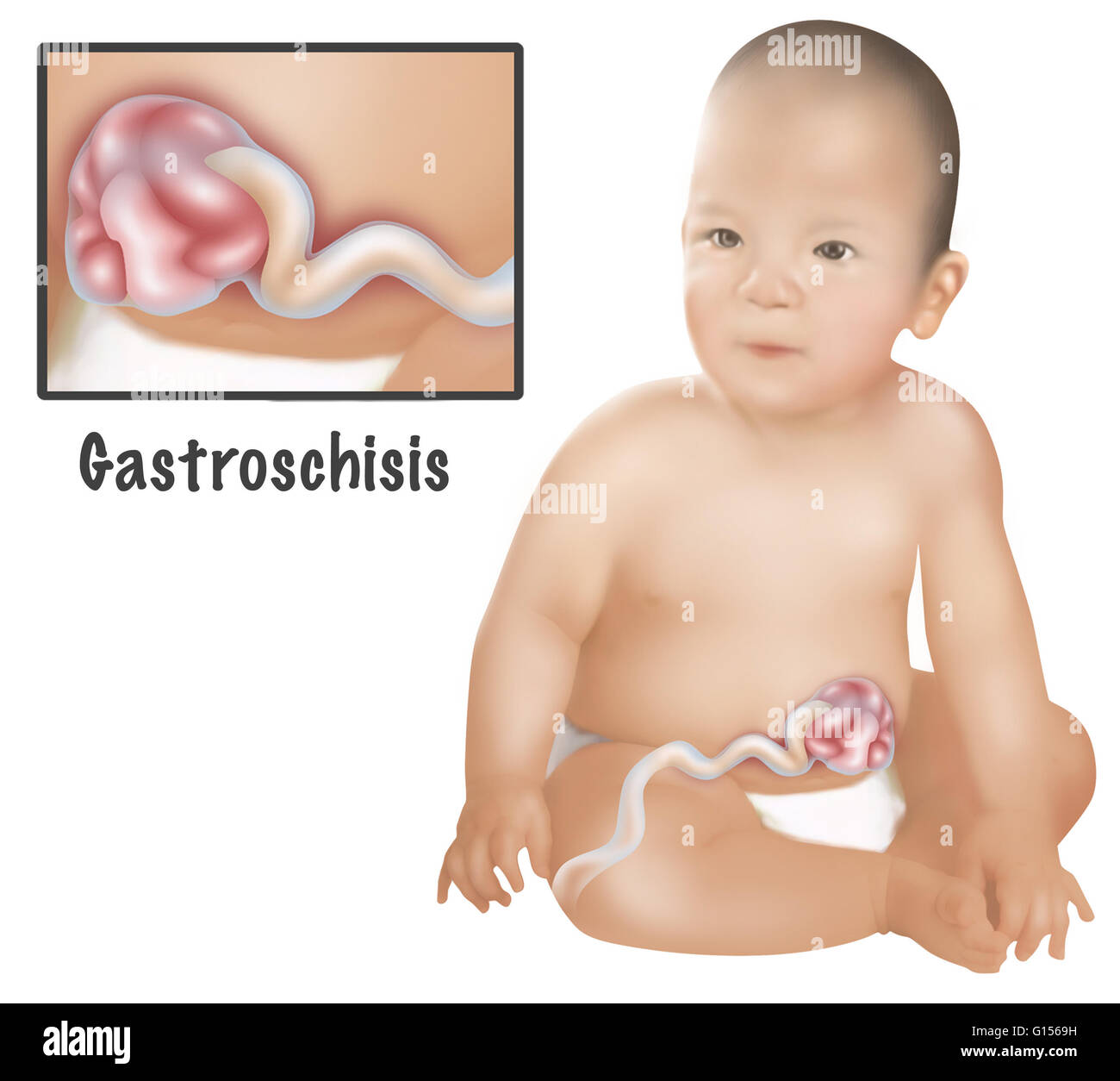 Une Illustration D Un Bebe Avec Le Gastroschisis Le Gastroschisis Est Un Defaut Congenital Dans La Paroi Abdominale Anterieure Qui Permet Pour Le Contenu Du Systeme Digestif Pour Depasser 1 Bebe En 30 Une Illustration D Un Bebe Avec Le Gastroschisis Le Gastroschisis Est Un Defaut Congenital Dans La Paroi Abdominale Anterieure Qui Permet Pour Le Contenu Du Systeme Digestif Pour Depasser 1 Bebe En 30