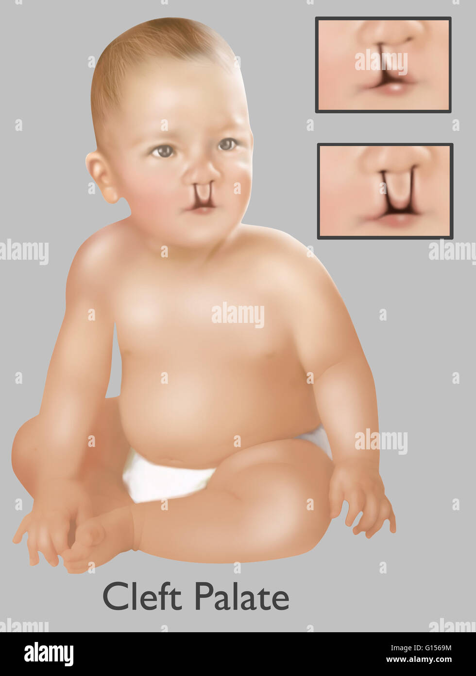 Une Illustration D Un Bebe Avec Une Fente Palatine Une Fente Palatine Est Une Malformation Sympathique Entrainant Une Ouverture Dans La Levre Superieure Par L Echec De La Structures Du Visage De Fusible La