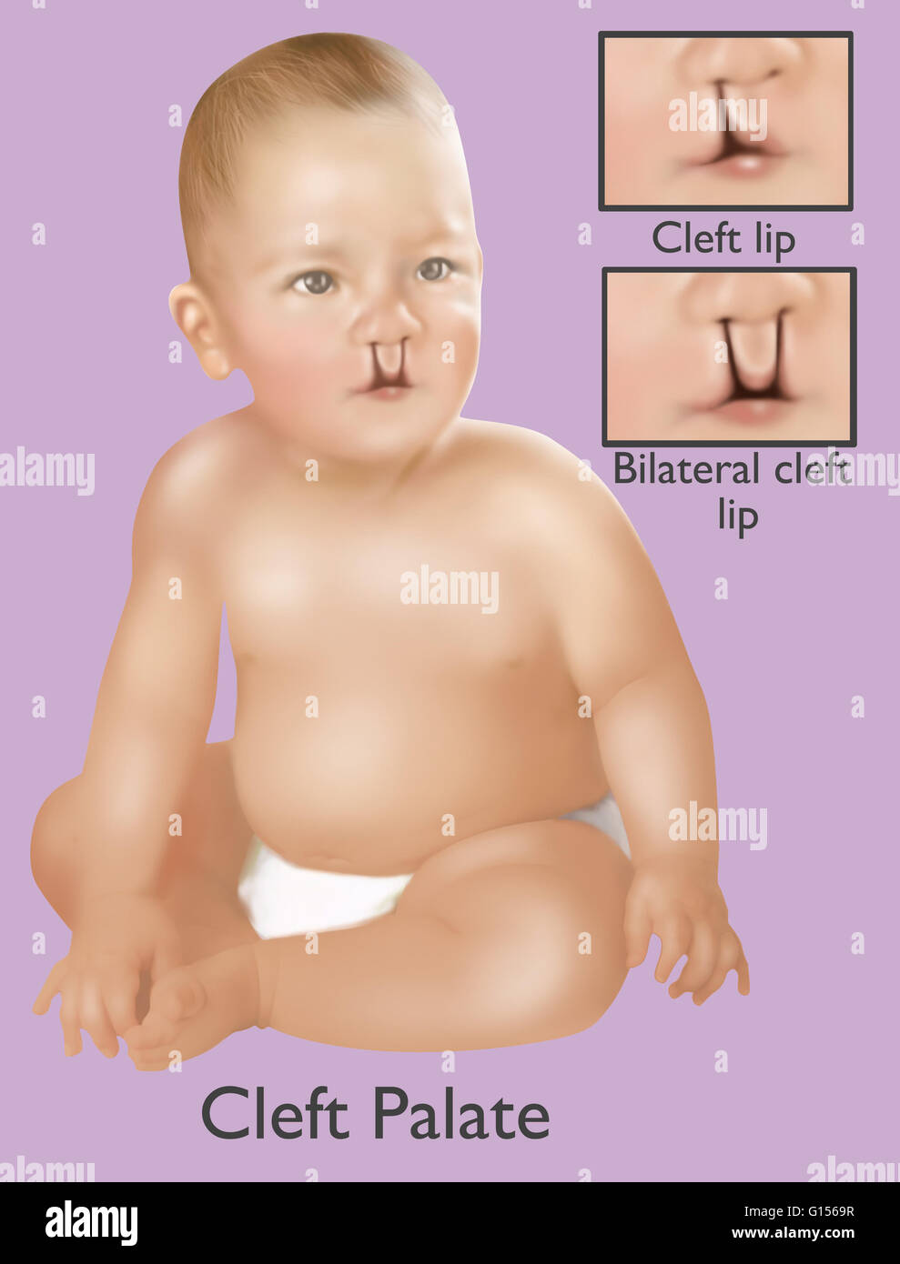 Une Illustration D Un Bebe Avec Une Fente Palatine Une Fente Palatine Est Une Malformation Sympathique Entrainant Une Ouverture Dans La Levre Superieure Par L Echec De La Structures Du Visage De Fusible La