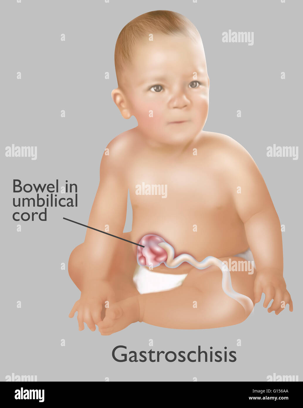 Une Illustration D Un Bebe Avec Le Gastroschisis Le Gastroschisis Est Un Defaut Congenital Dans La Paroi Abdominale Anterieure Qui Permet Pour Le Contenu Du Systeme Digestif Pour Depasser 1 Bebe En 30 Une Illustration D Un Bebe Avec Le Gastroschisis Le Gastroschisis Est Un Defaut Congenital Dans La Paroi Abdominale Anterieure Qui Permet Pour Le Contenu Du Systeme Digestif Pour Depasser 1 Bebe En 30