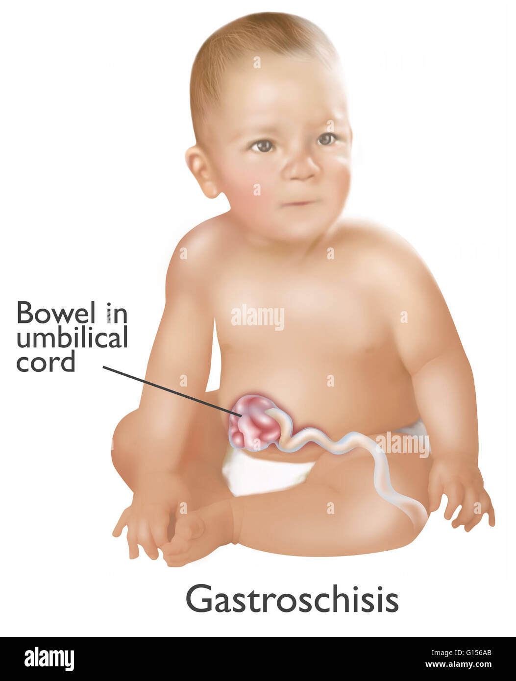 Une Illustration D Un Bebe Avec Le Gastroschisis Le Gastroschisis Est Un Defaut Congenital Dans La Paroi Abdominale Anterieure Qui Permet Pour Le Contenu Du Systeme Digestif Pour Depasser 1 Bebe En 30 Une Illustration D Un Bebe Avec Le Gastroschisis Le Gastroschisis Est Un Defaut Congenital Dans La Paroi Abdominale Anterieure Qui Permet Pour Le Contenu Du Systeme Digestif Pour Depasser 1 Bebe En 30