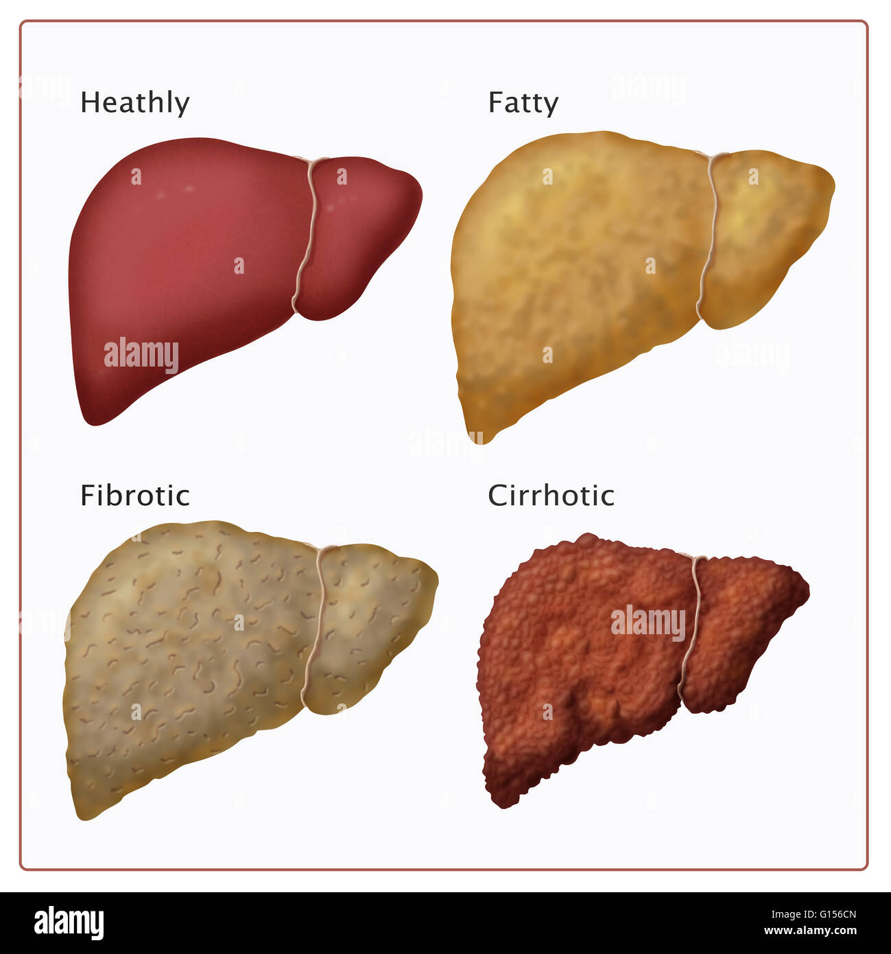 Étapes de l'atteinte hépatique. À partir de la santé du foie (en haut à gauche), les dépôts de graisse cause hépatomégalie (stéatose hépatique ou d'une maladie du foie gras), les formulaires et plus les cellules du foie se produit (fibrose), enfin des tissus cicatriciels rend le disque du foie et de l'ONU Banque D'Images