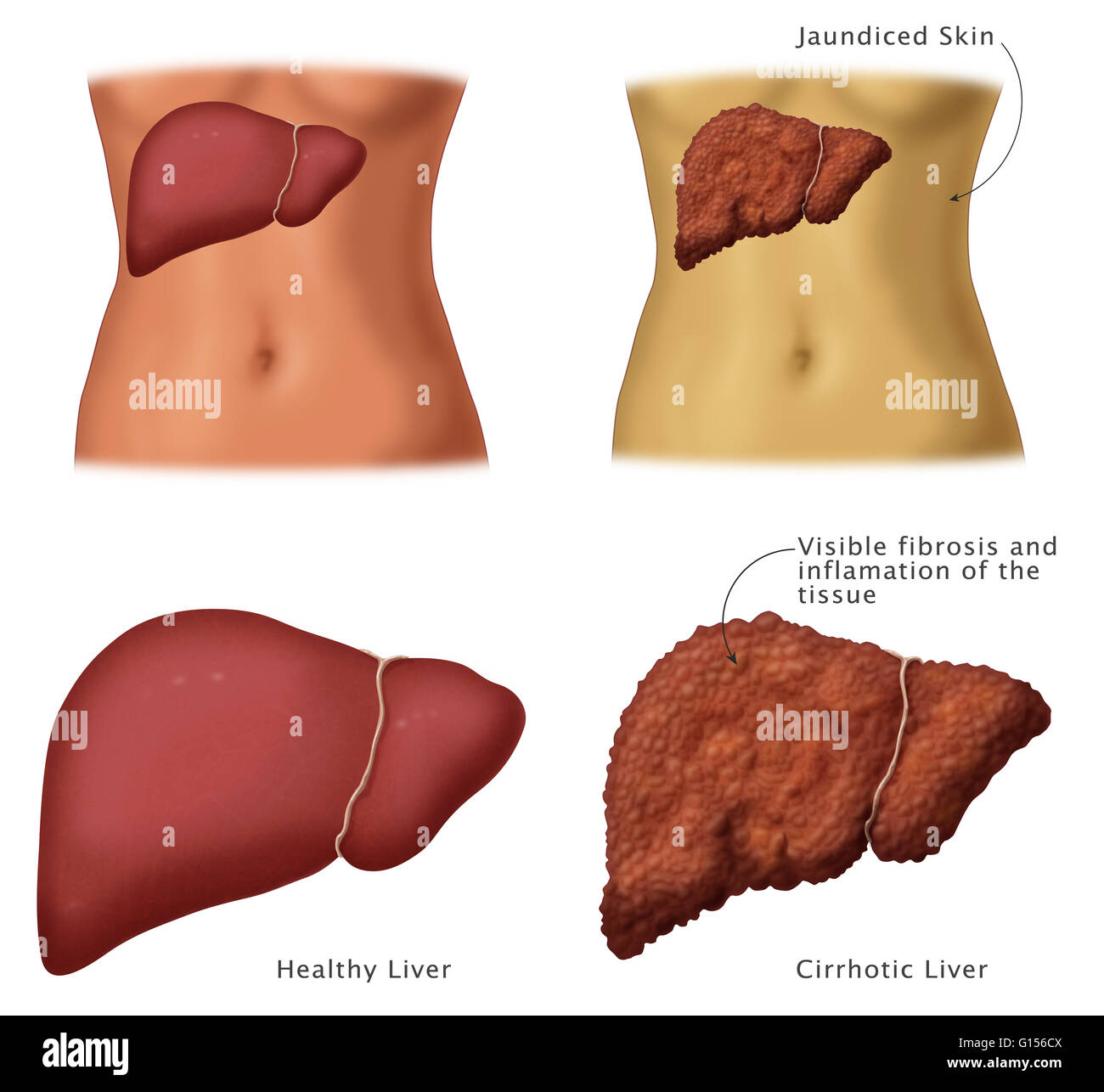 Illustration montrant un foie sain (gauche) et du foie cirrhotique (droite). La cirrhose est la conséquence d'une maladie chronique du foie caractérisée par le remplacement des tissus du foie par la fibrose, des tissus cicatriciels et des nodules de régénération (grumeaux qui se produisent en raison d'un Banque D'Images