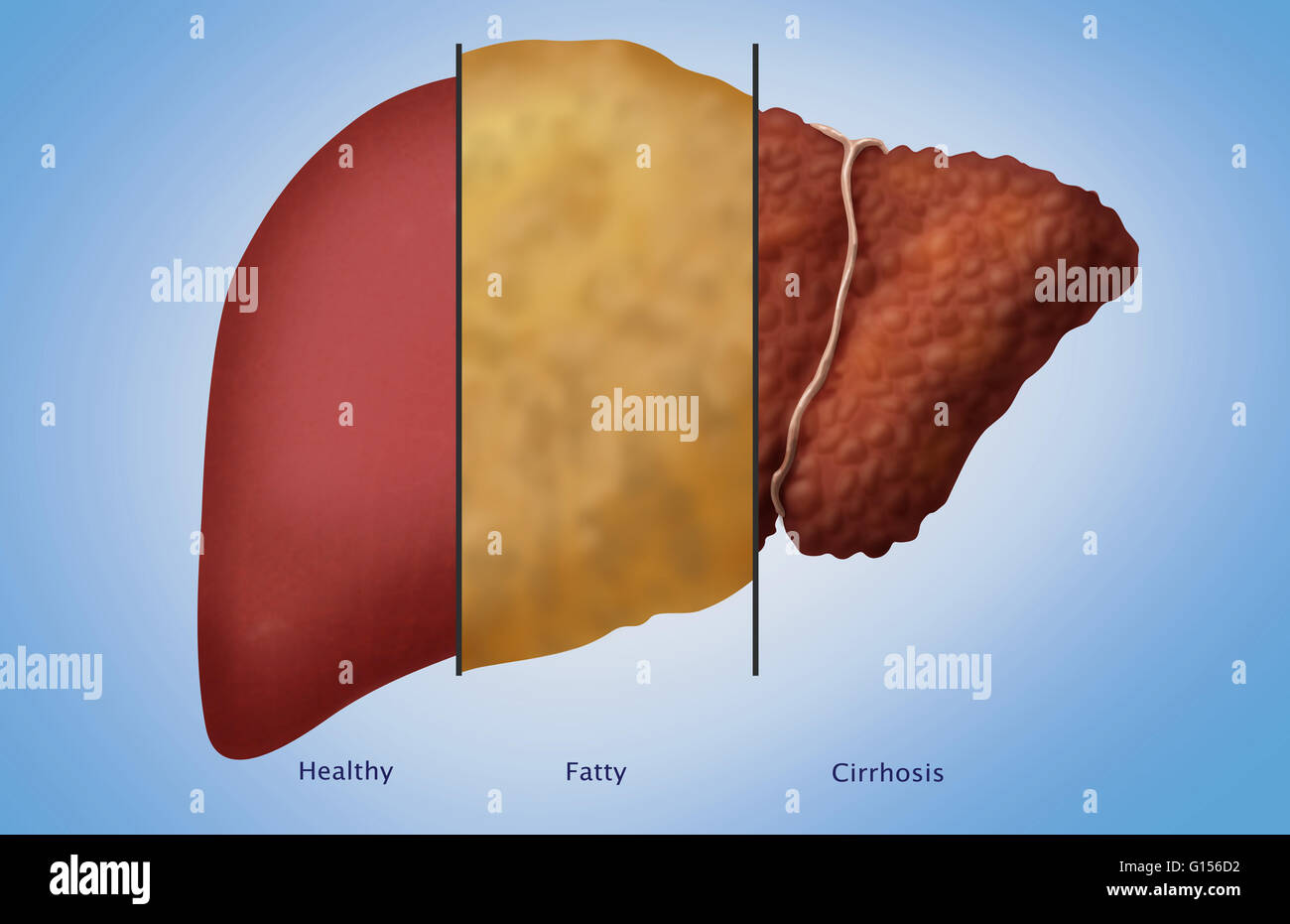 En comparant l'aspect de l'illustration (de gauche à droite) une saine, acides, et le foie cirrhotique. La stéatose hépatique est une condition réversible où de grandes vacuoles d'accumuler la graisse de triglycérides dans les cellules du foie via le processus de stéatose hépatique (p. ex., troubles de la r Banque D'Images